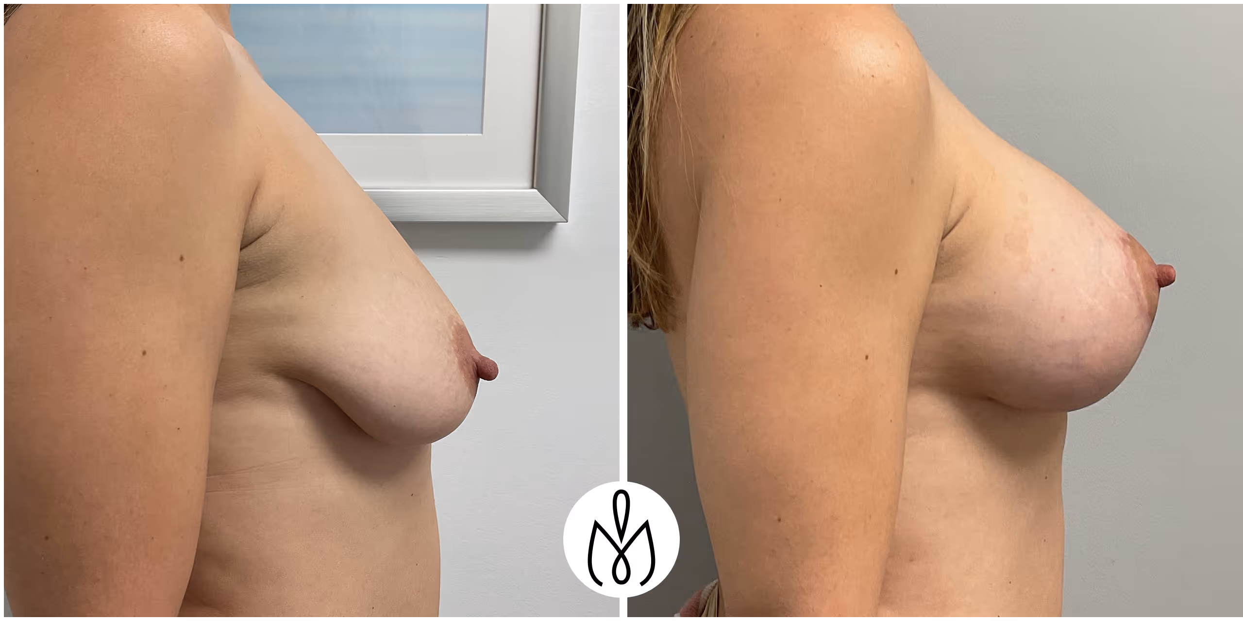 Before,After