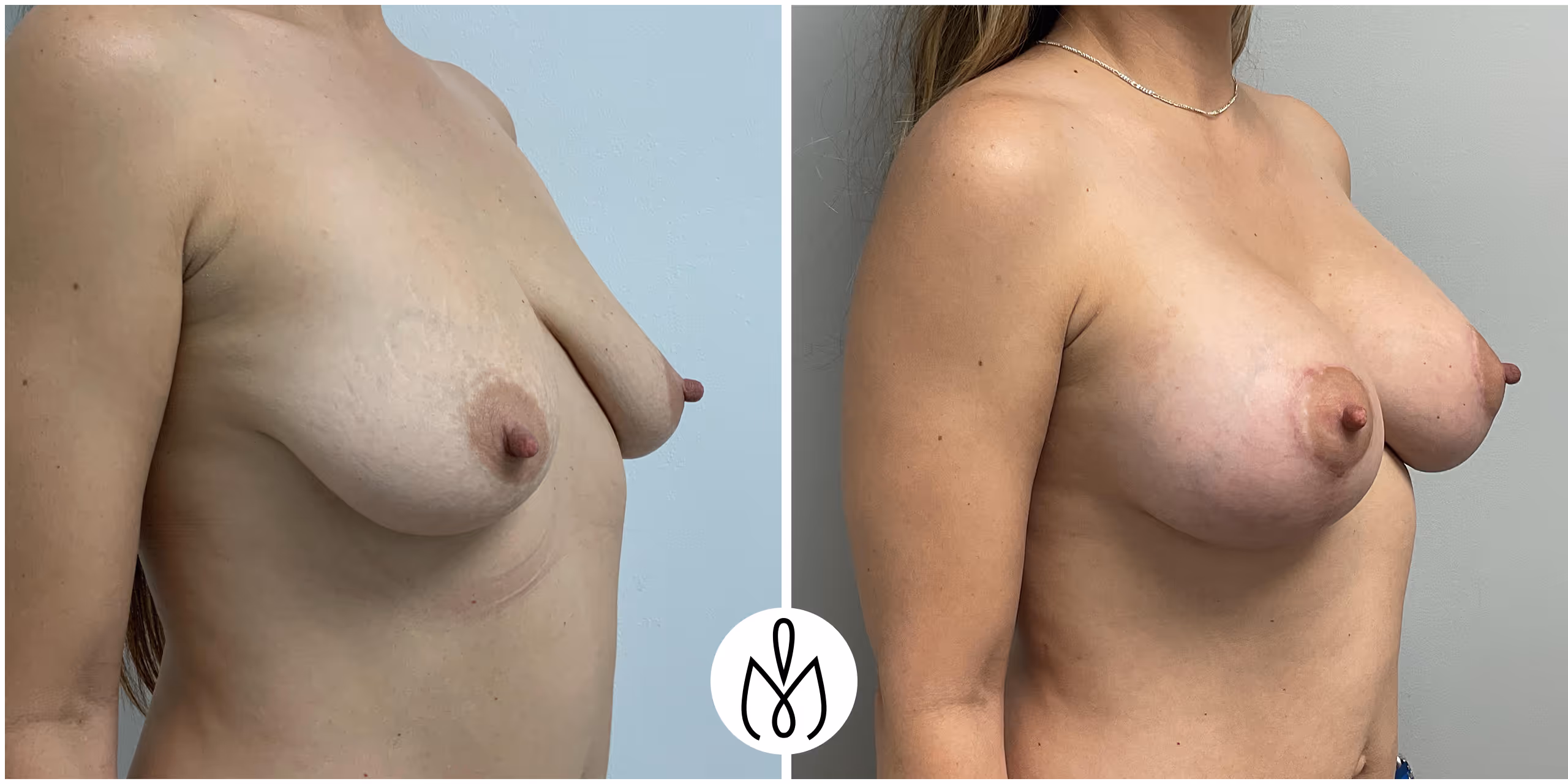 Before,After