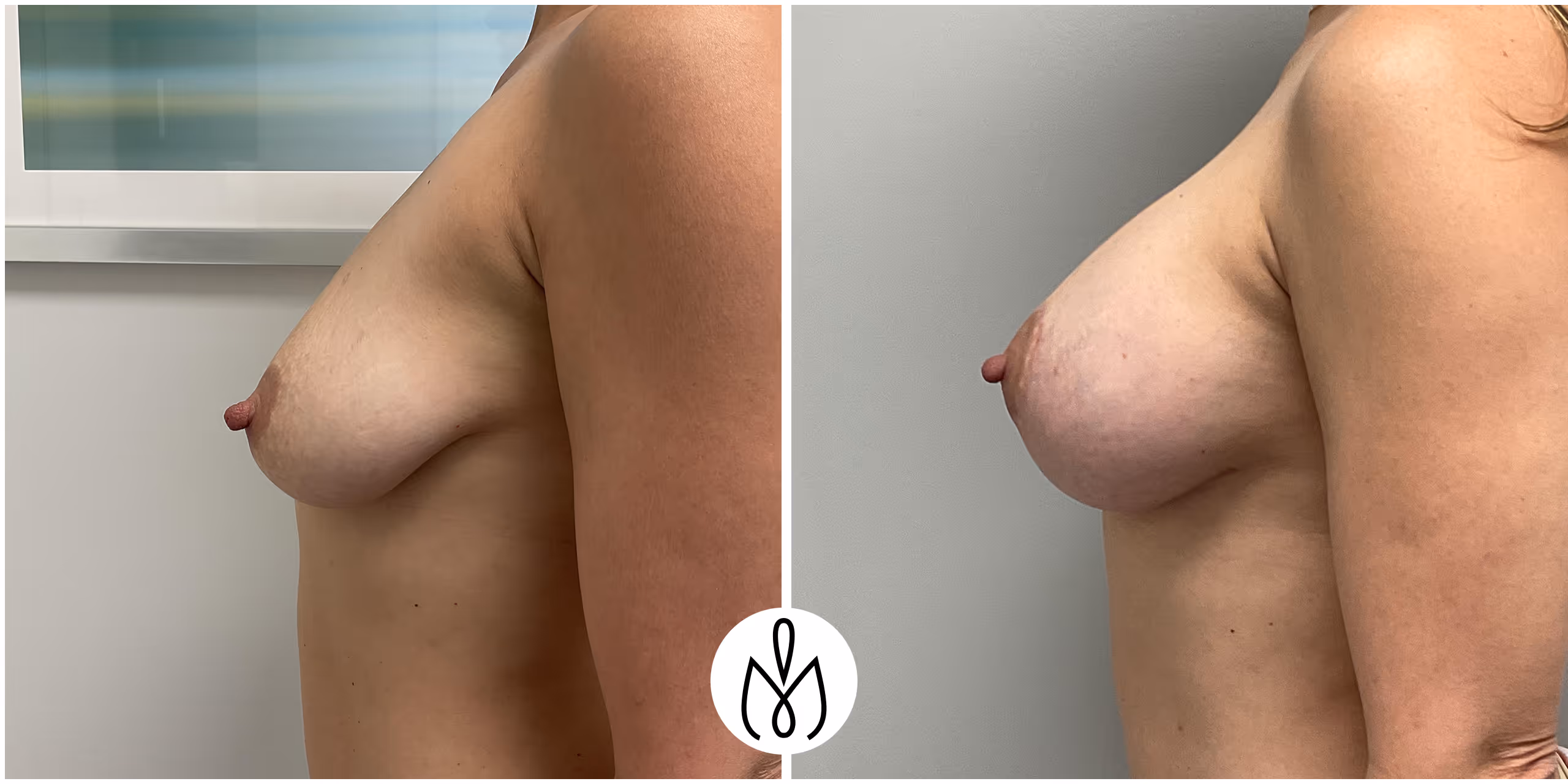 Before,After