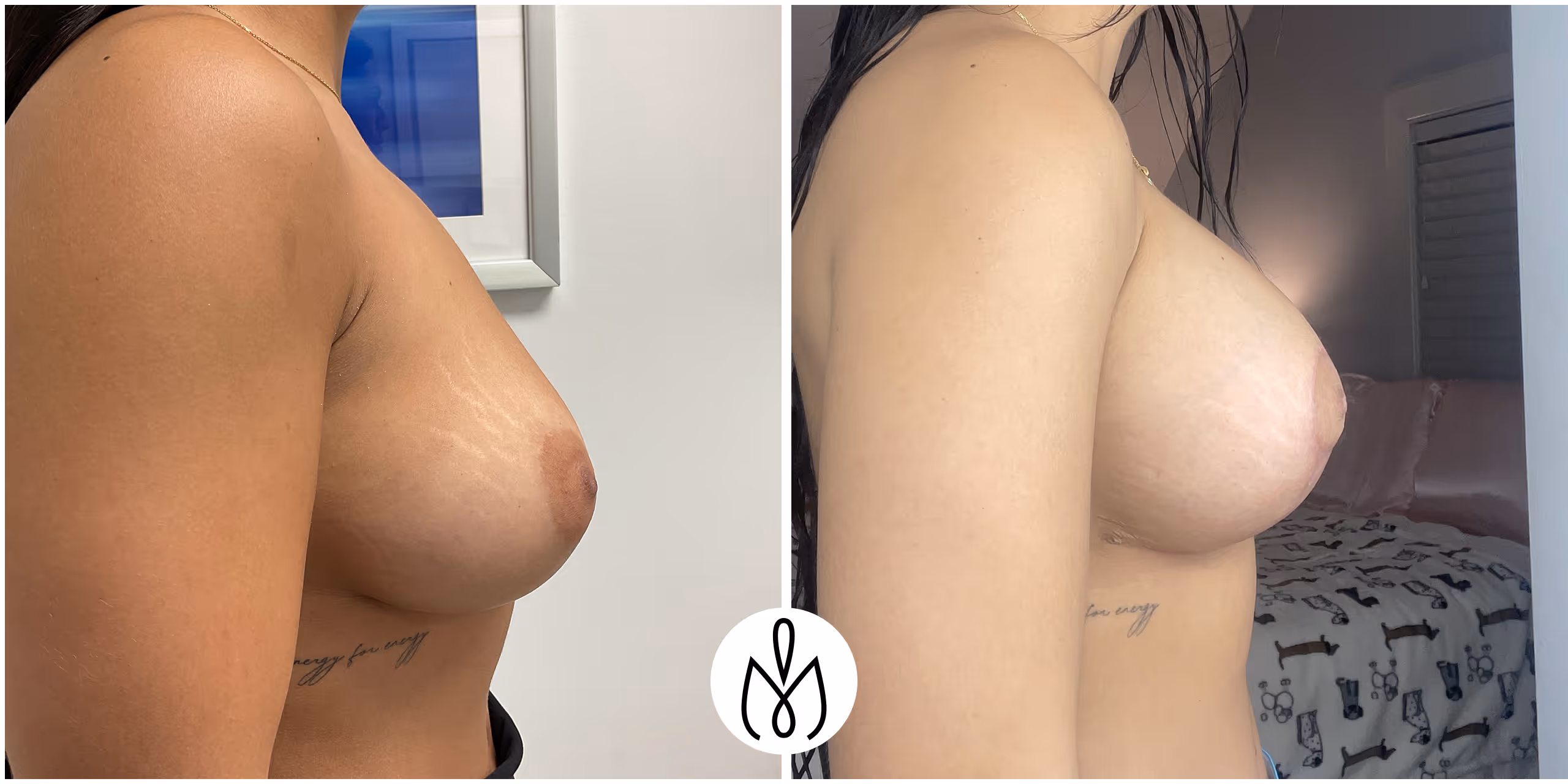 Before,After