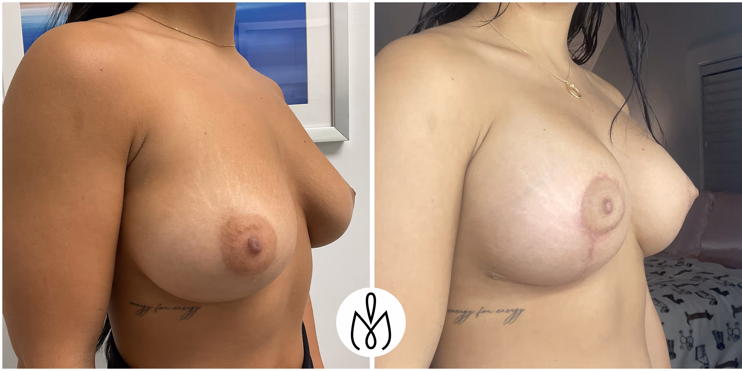 Before,After