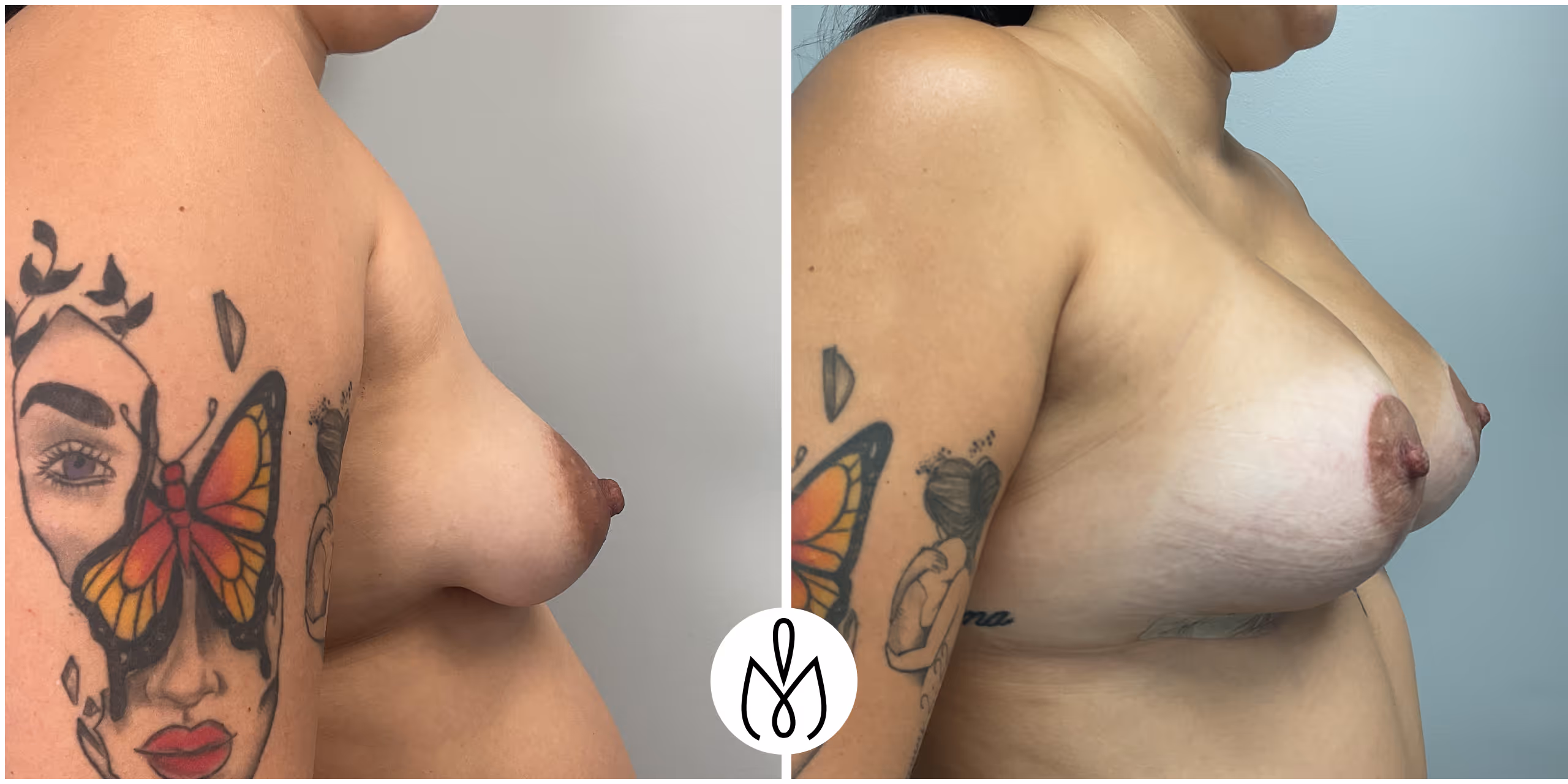 Before,After
