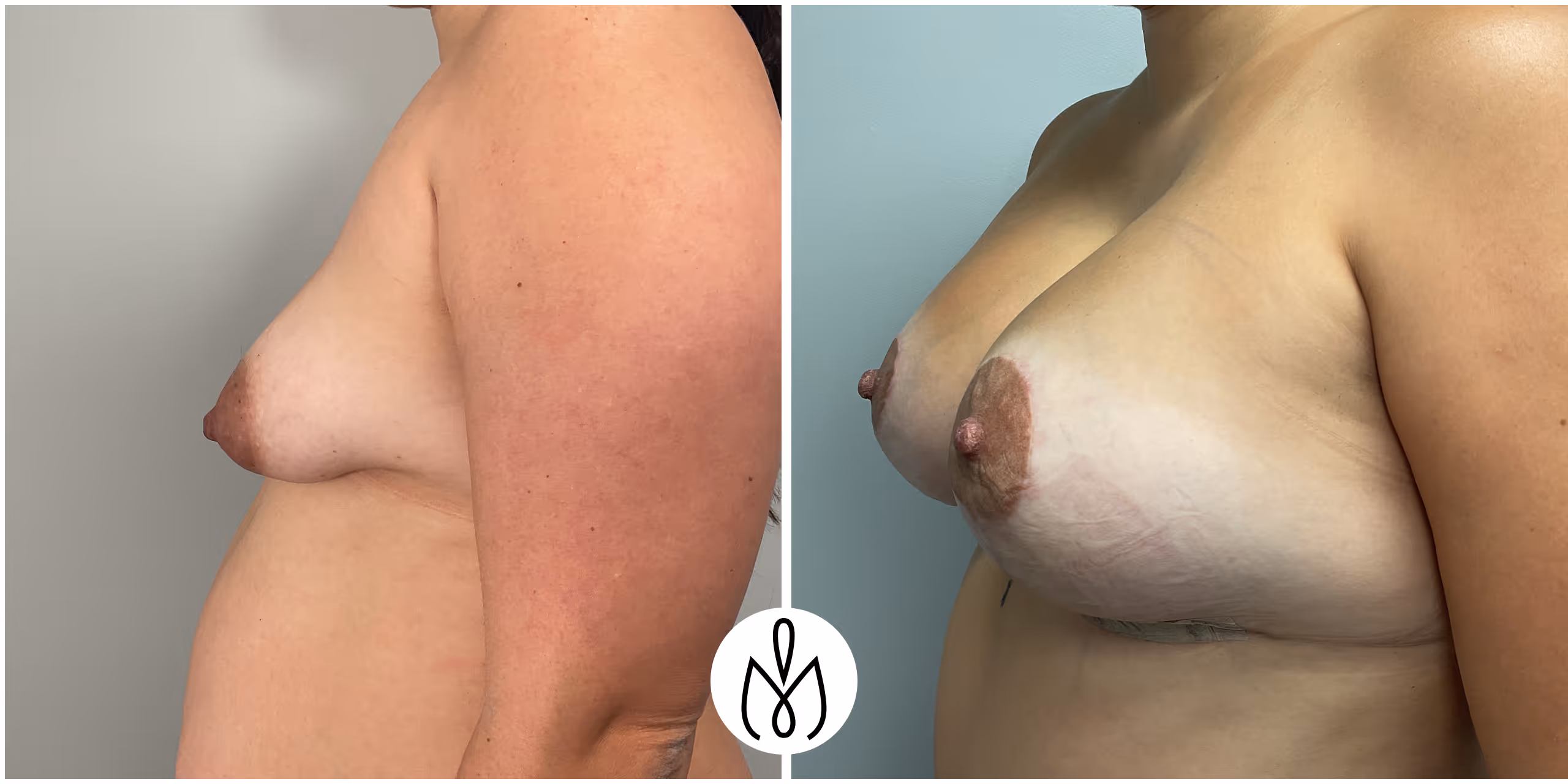 Before,After