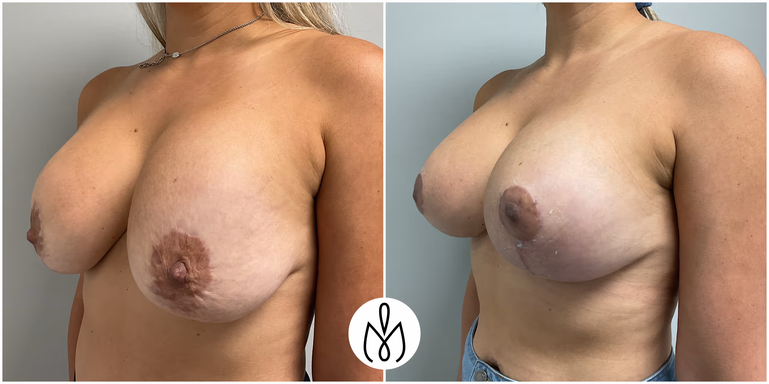 Before,After