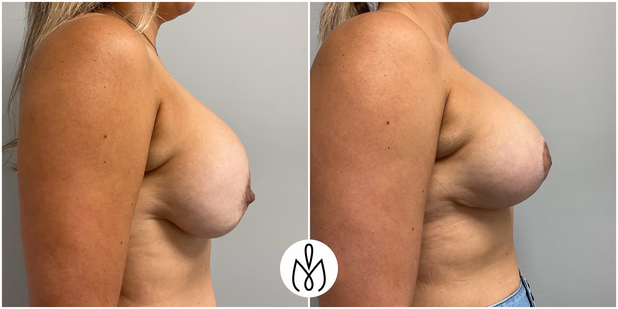 Before,After
