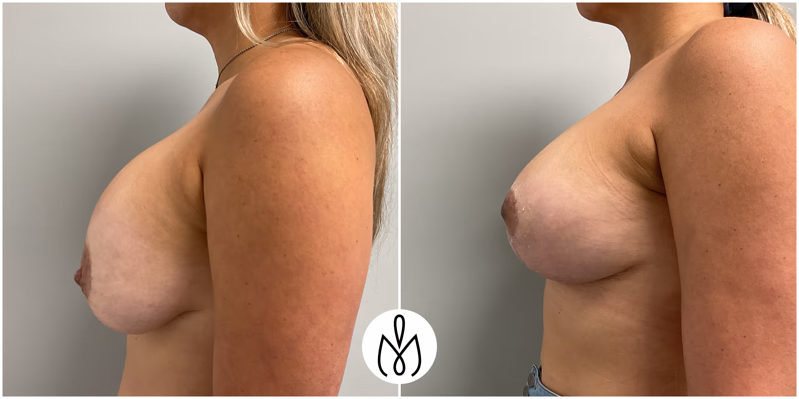 Before,After