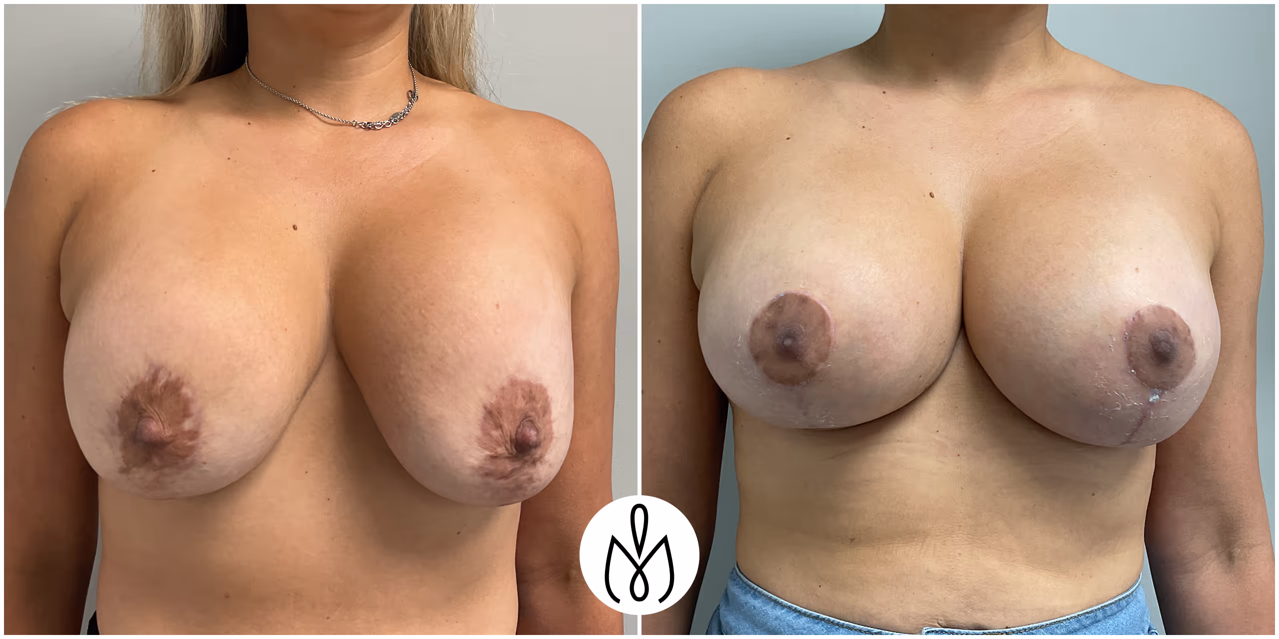 Before,After