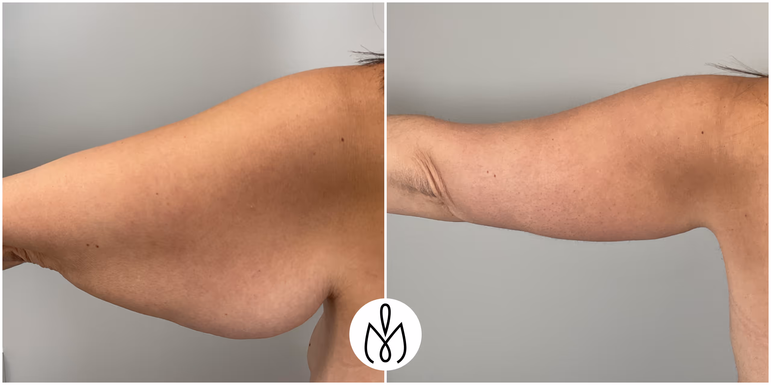 Before,After