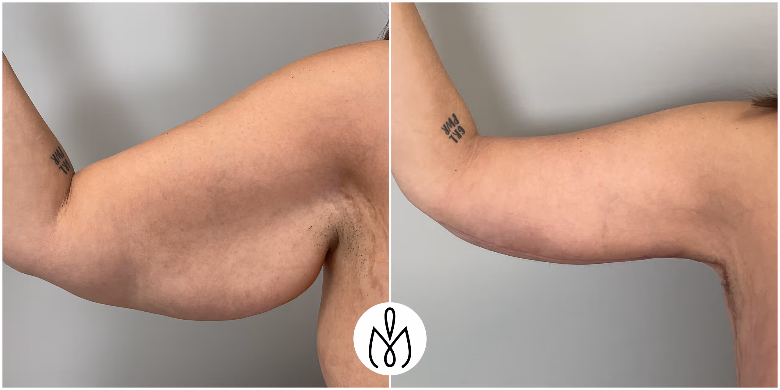 Before,After