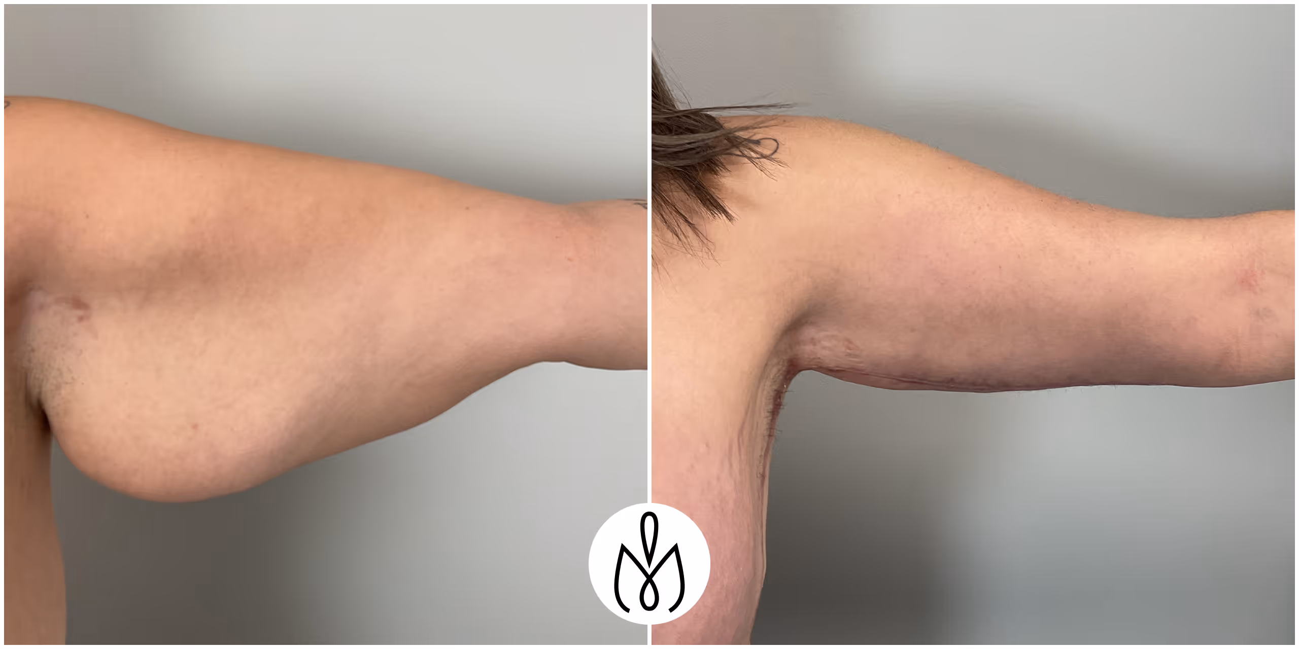 Before,After