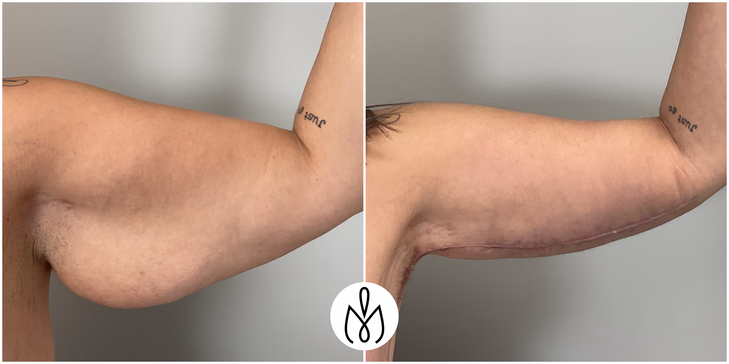 Before,After
