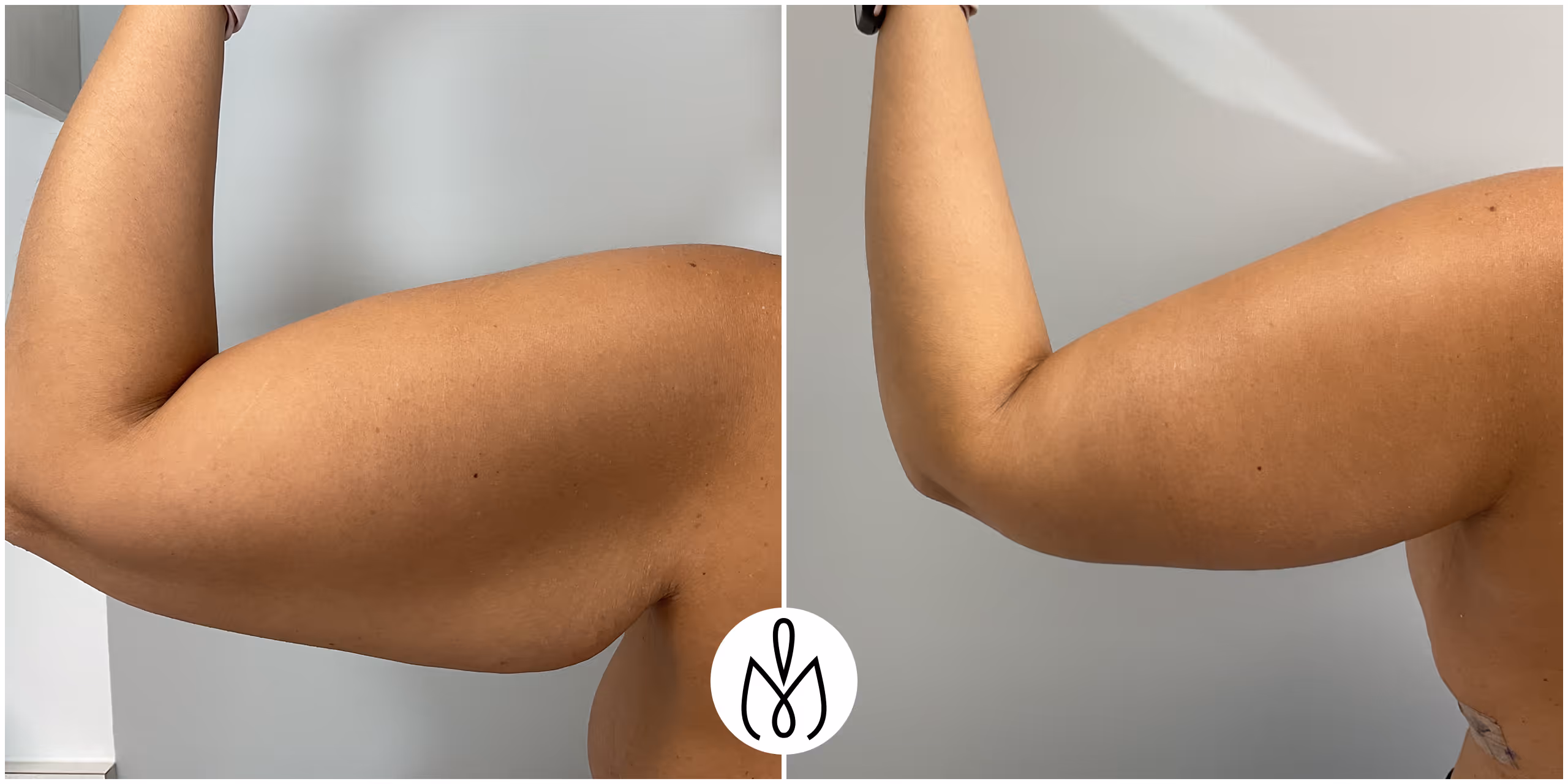 Before,After