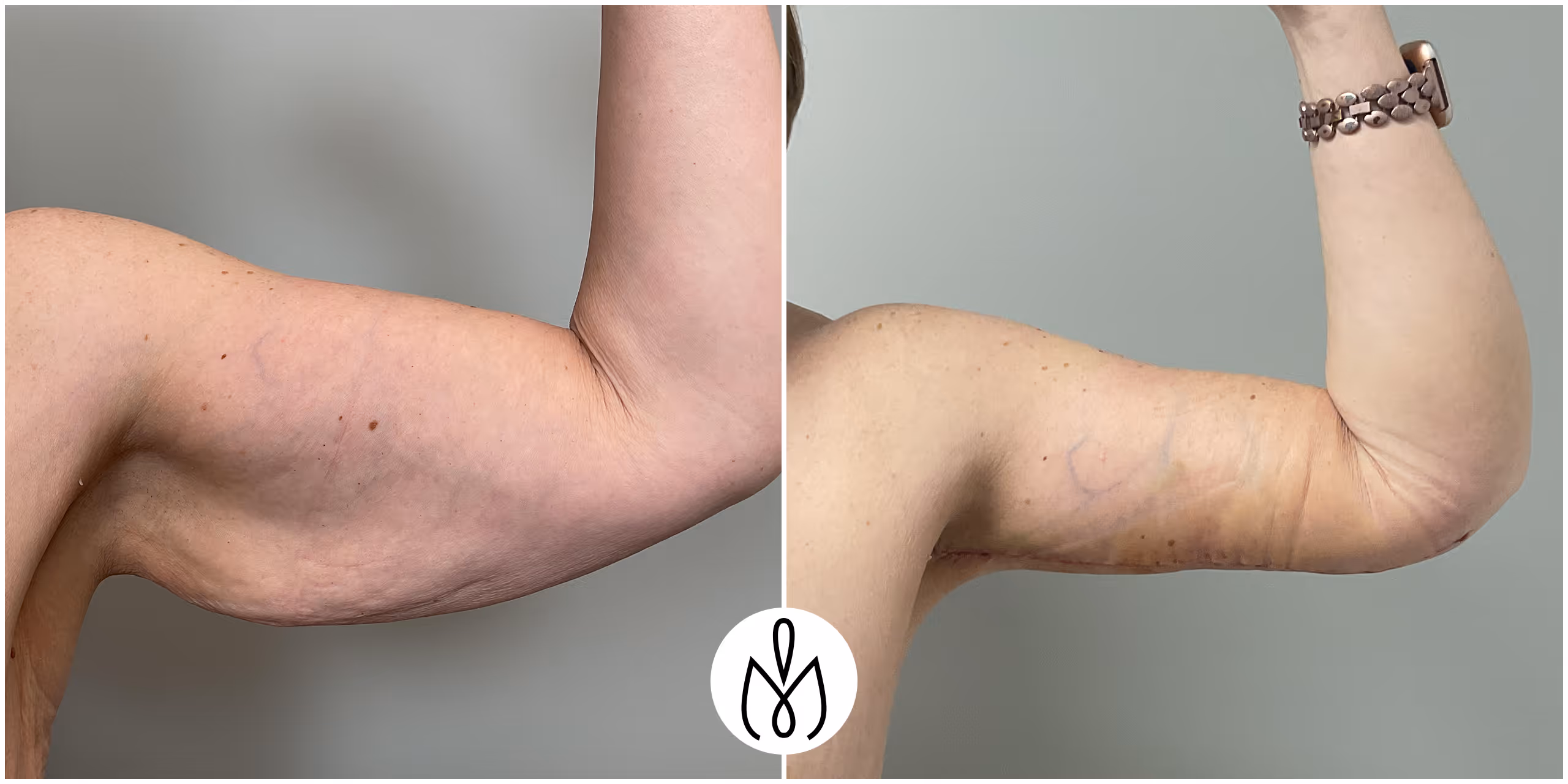 Before,After