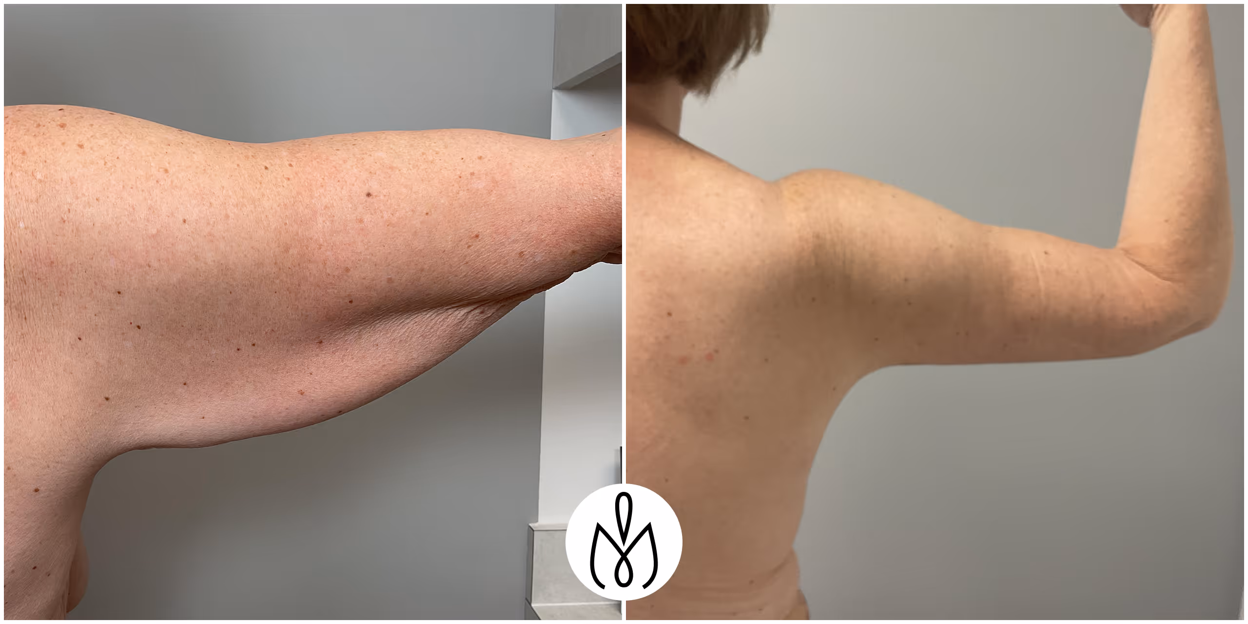 Before,After
