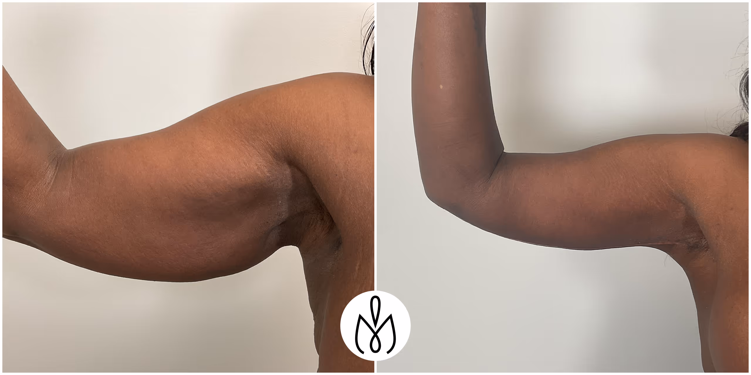 Before,After