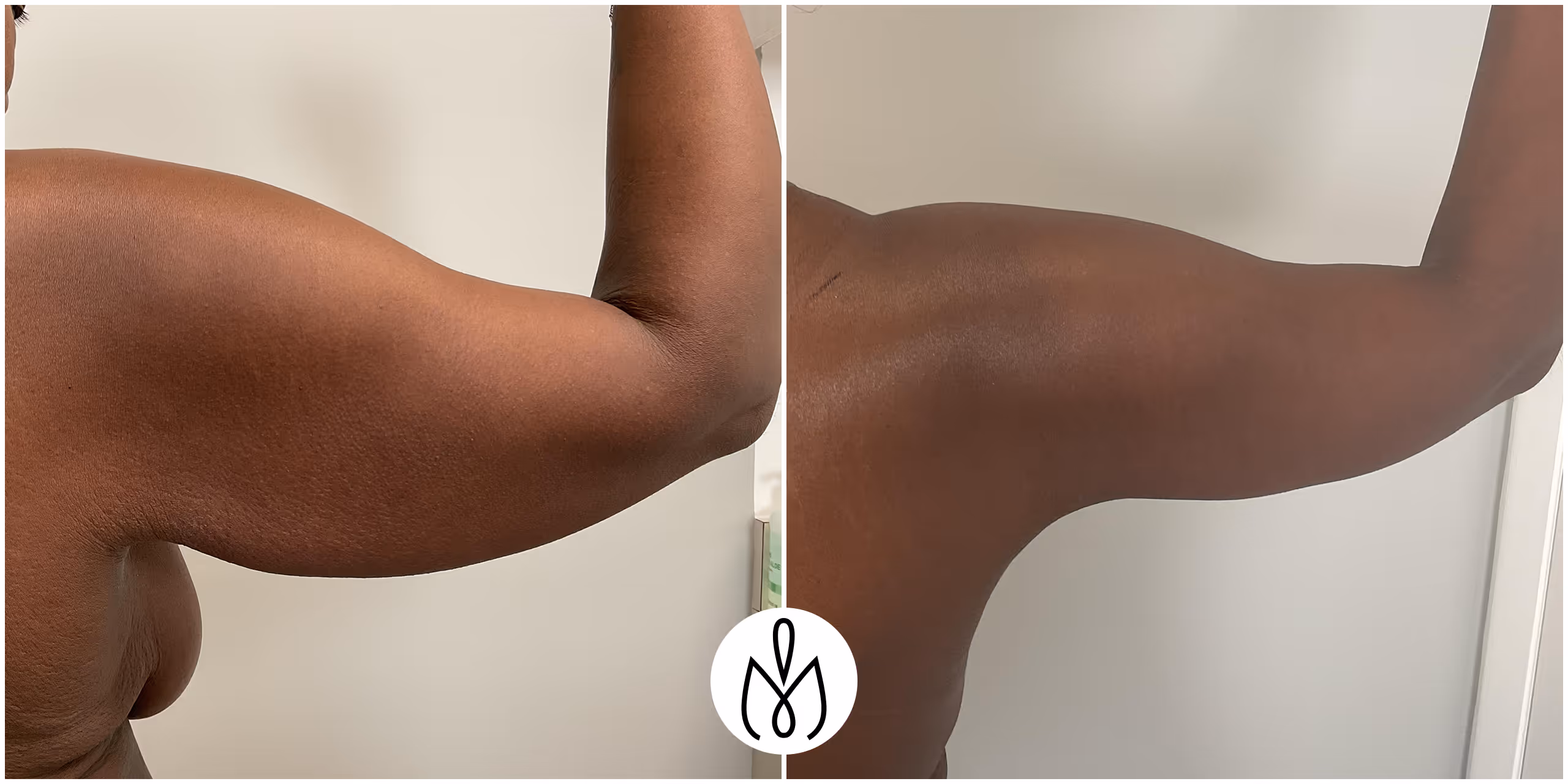 Before,After