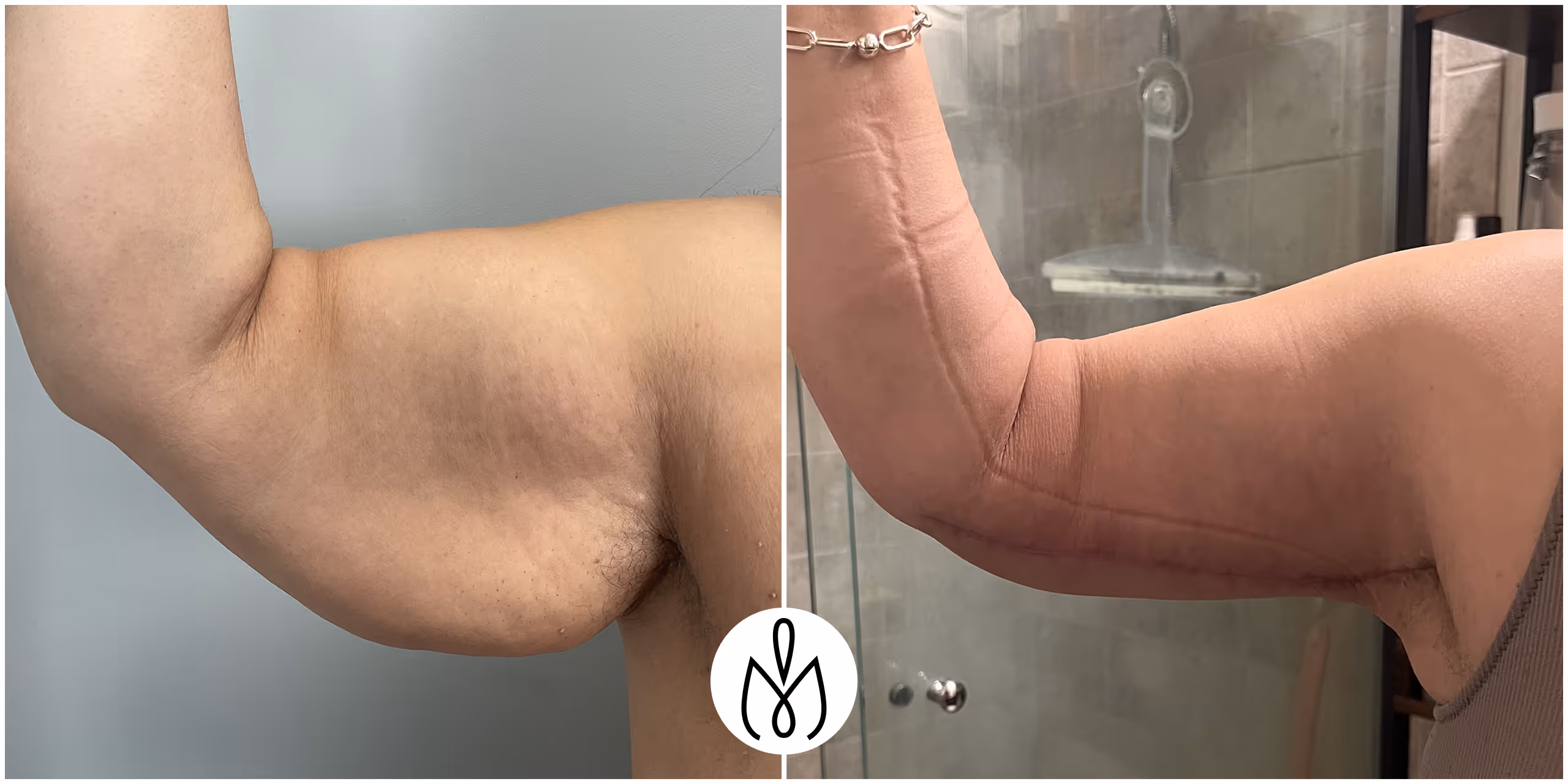 Before,After