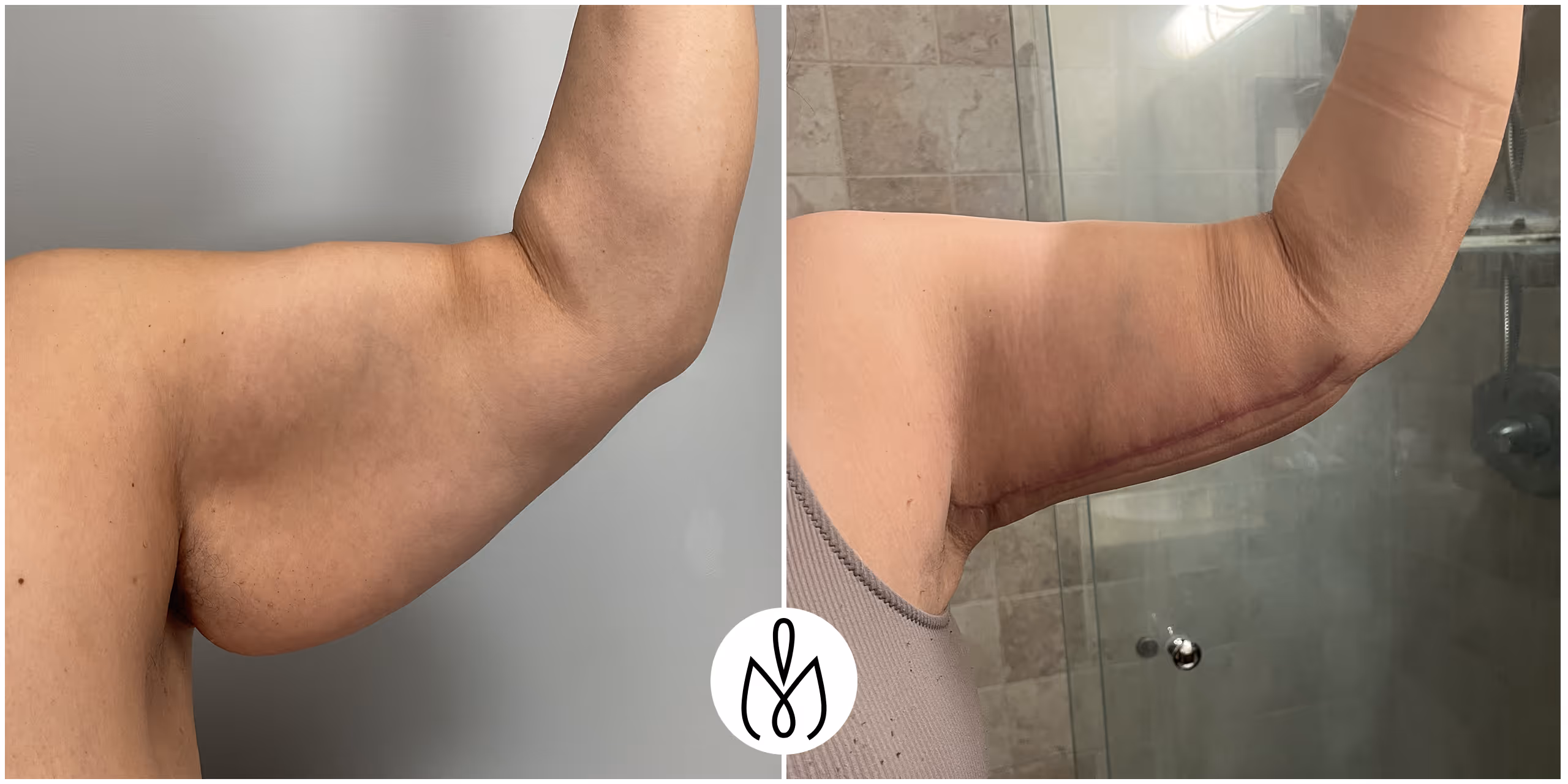 Before,After