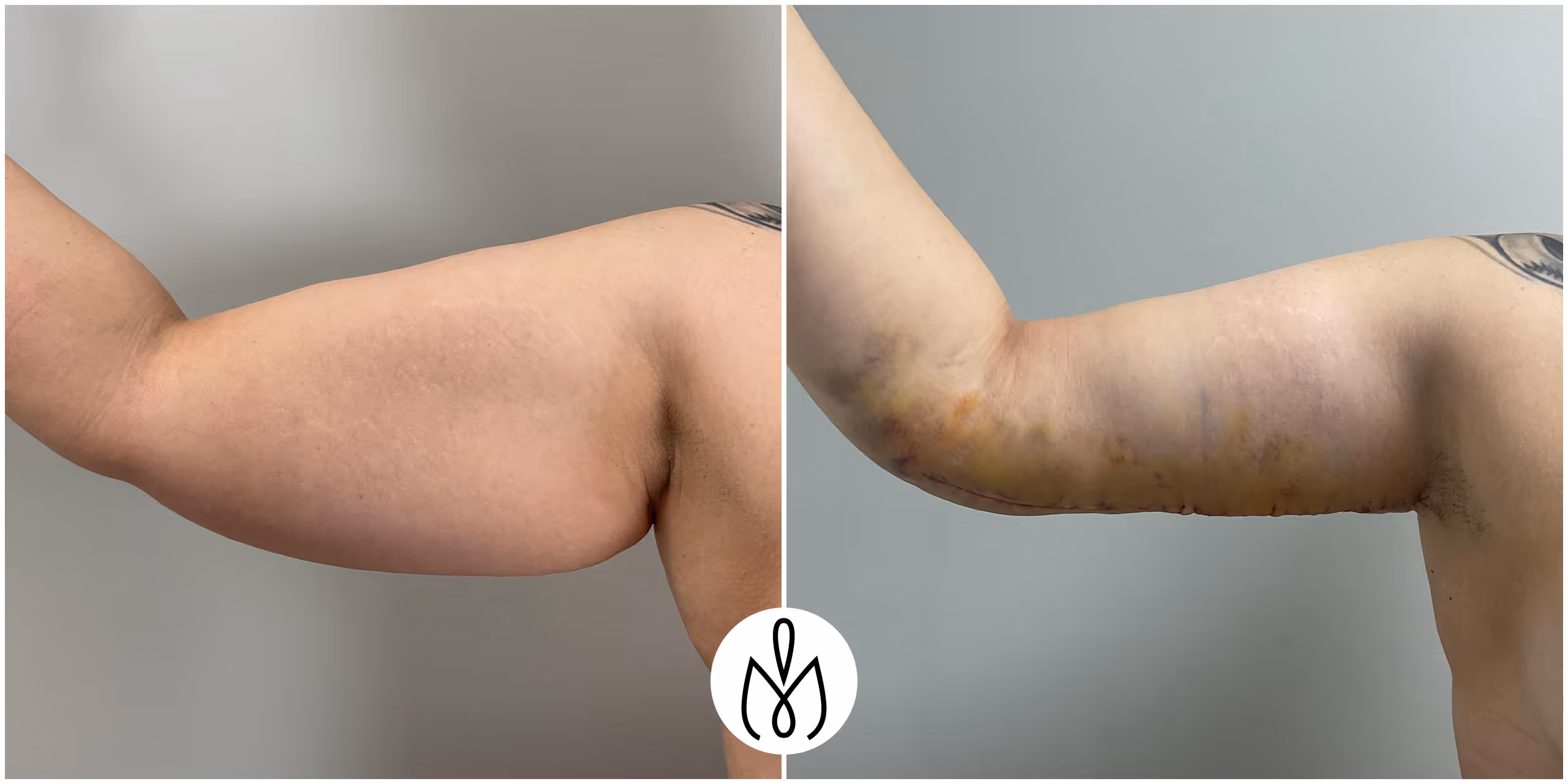 Before,After
