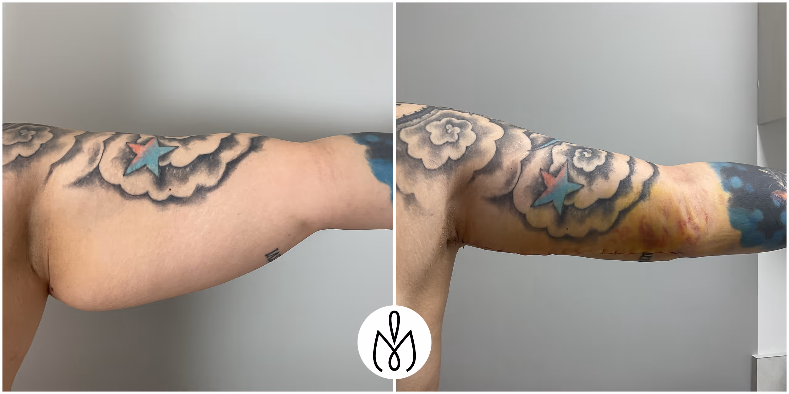 Before,After