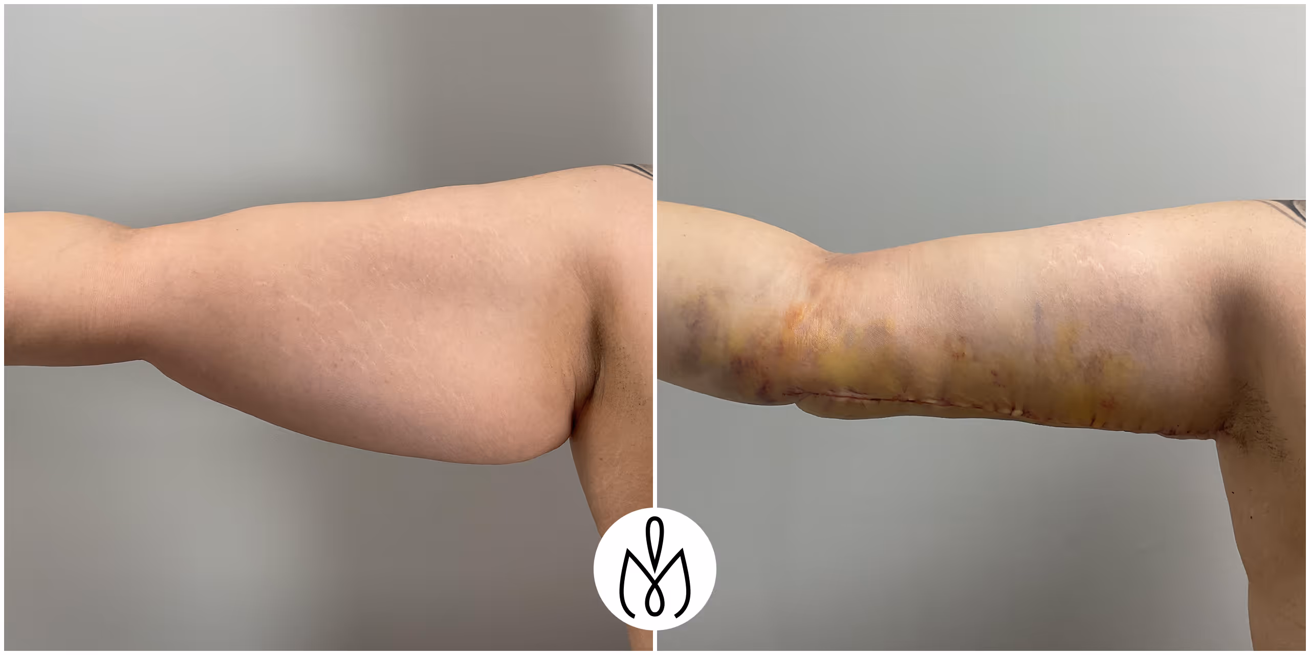 Before,After