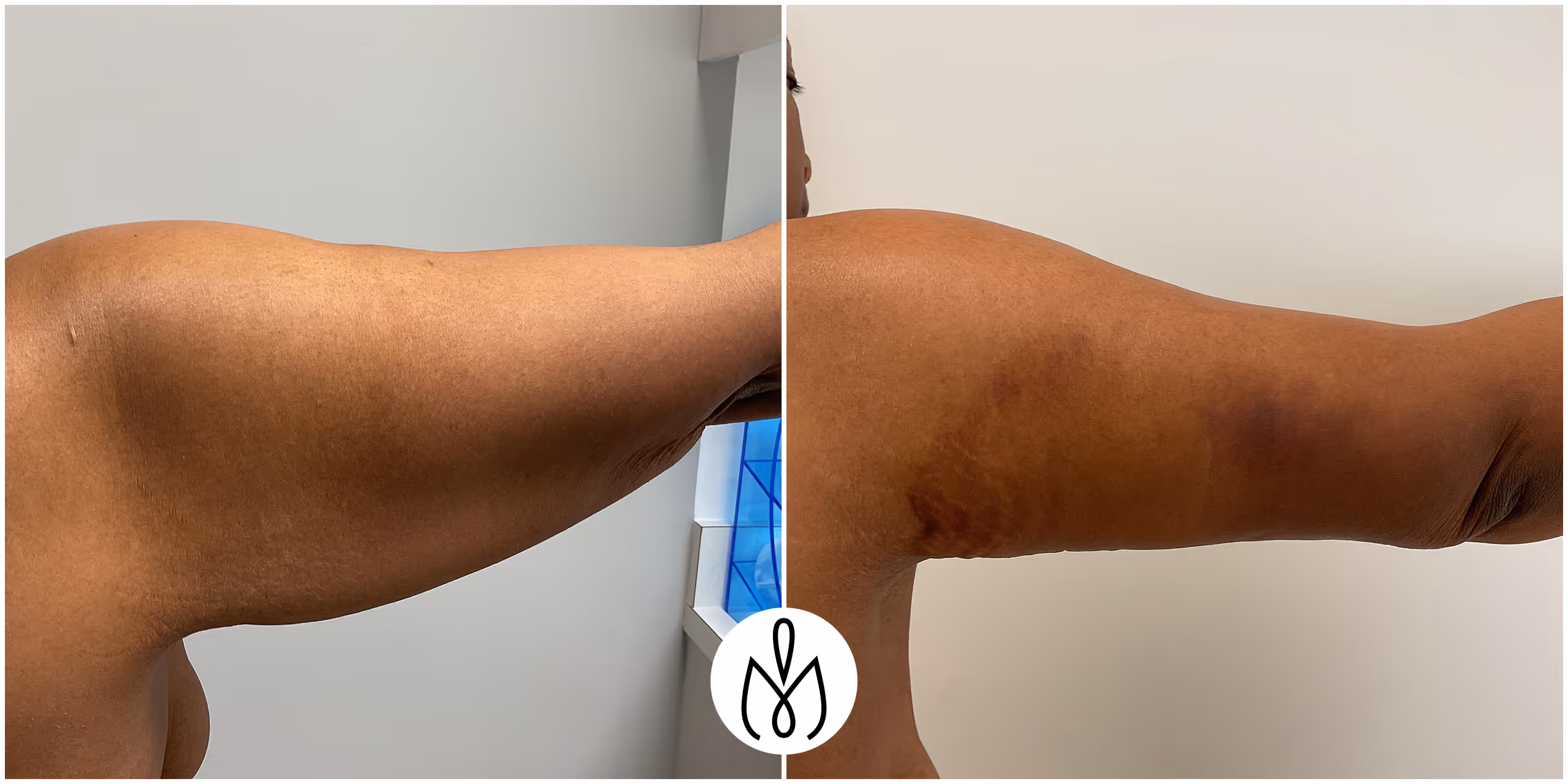 Before,After
