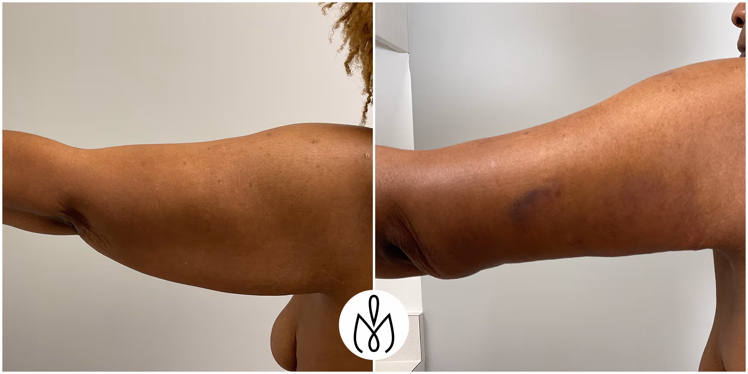 Before,After