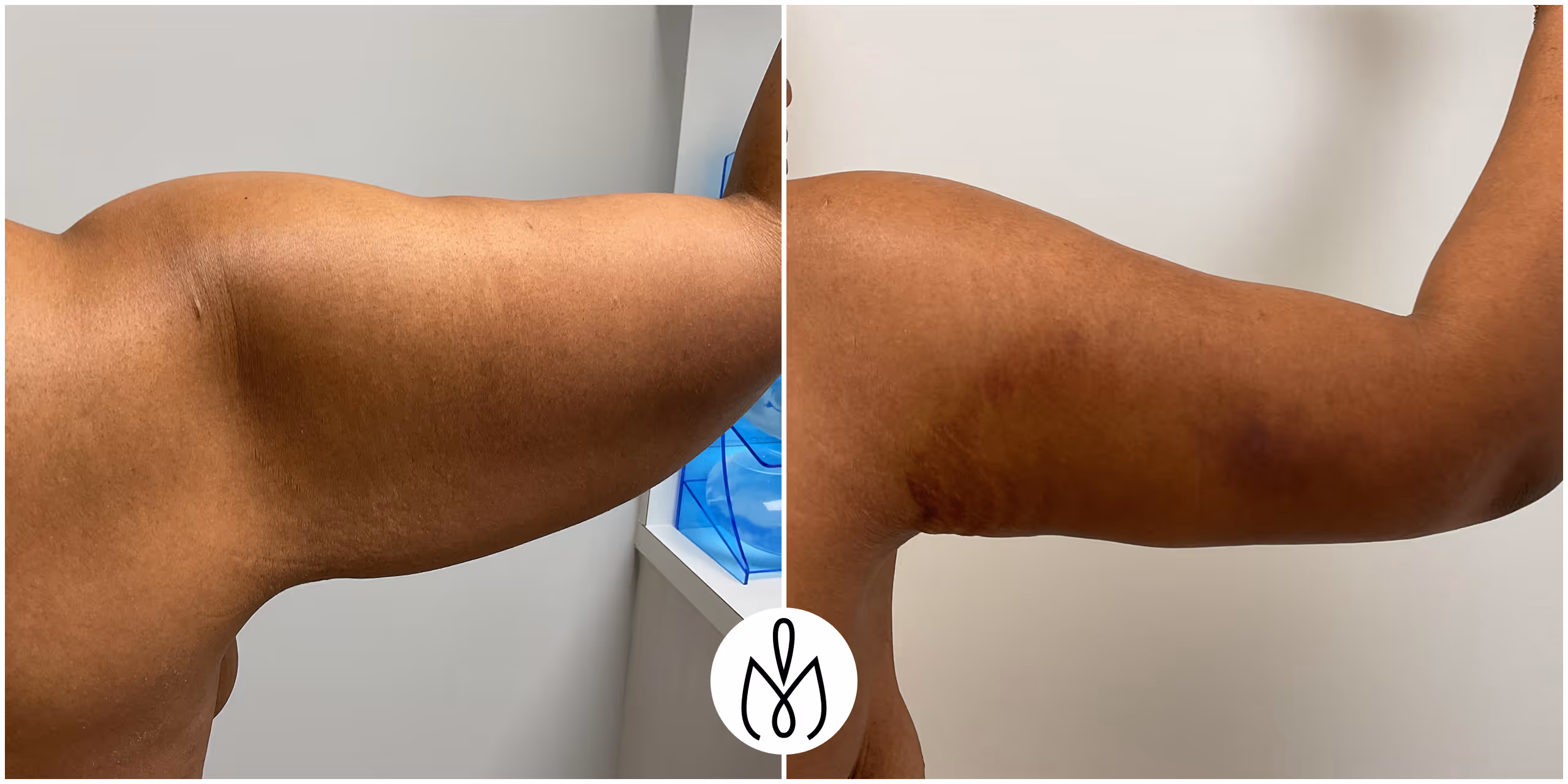 Before,After