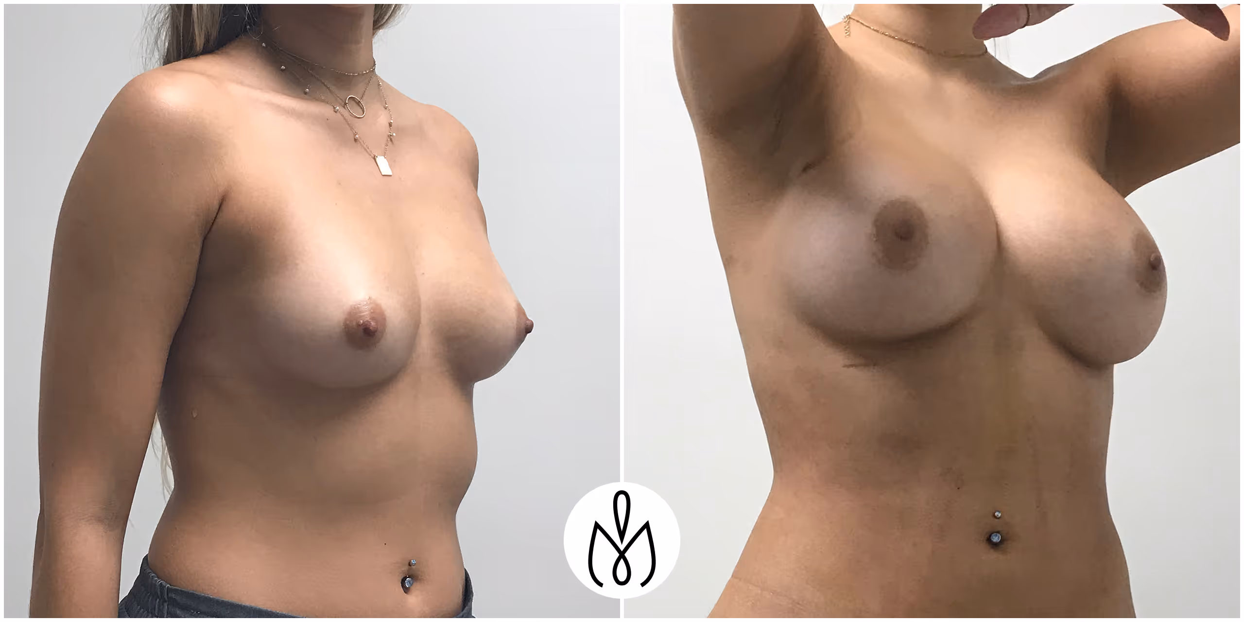 Before,After