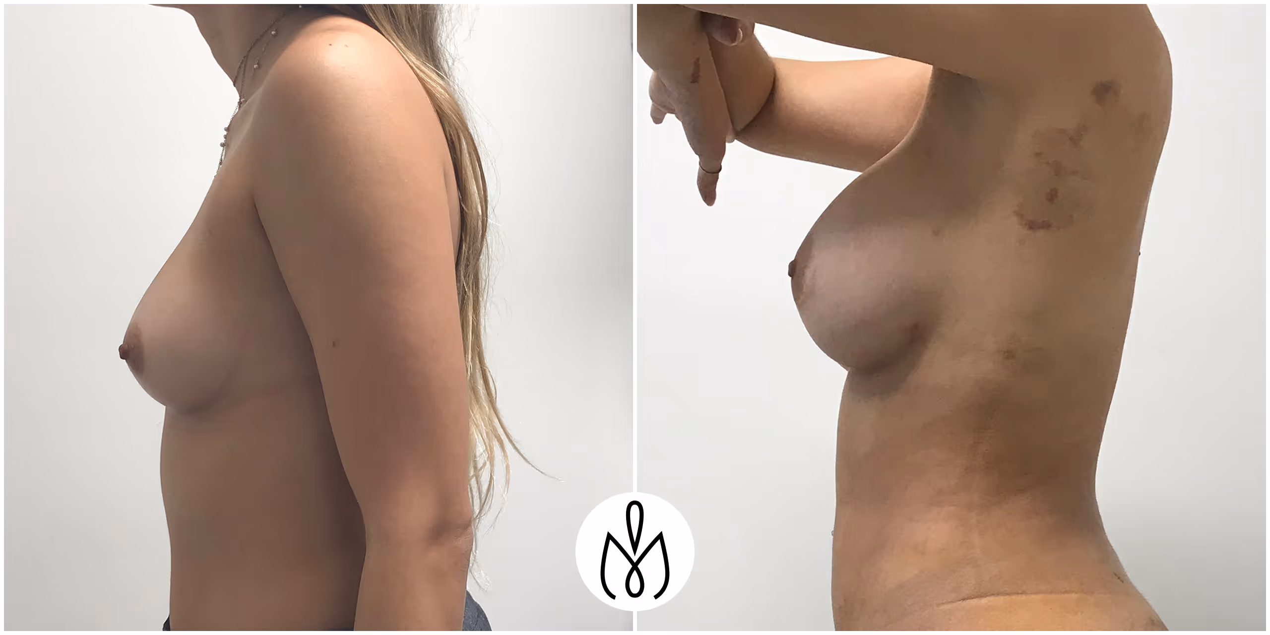 Before,After