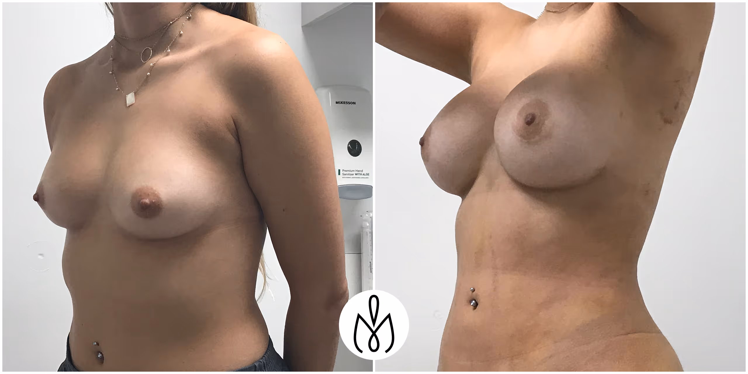 Before,After