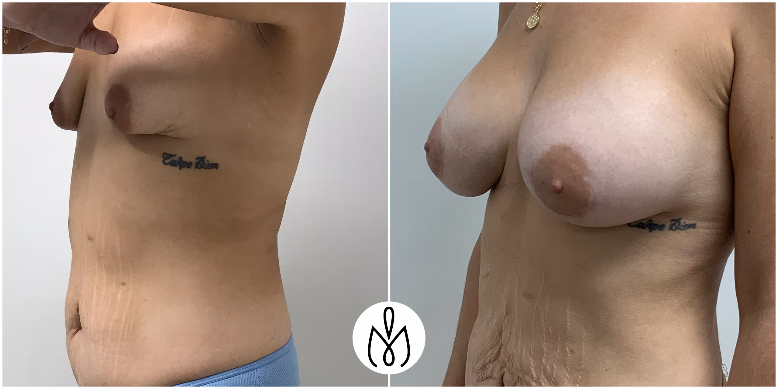 Before,After