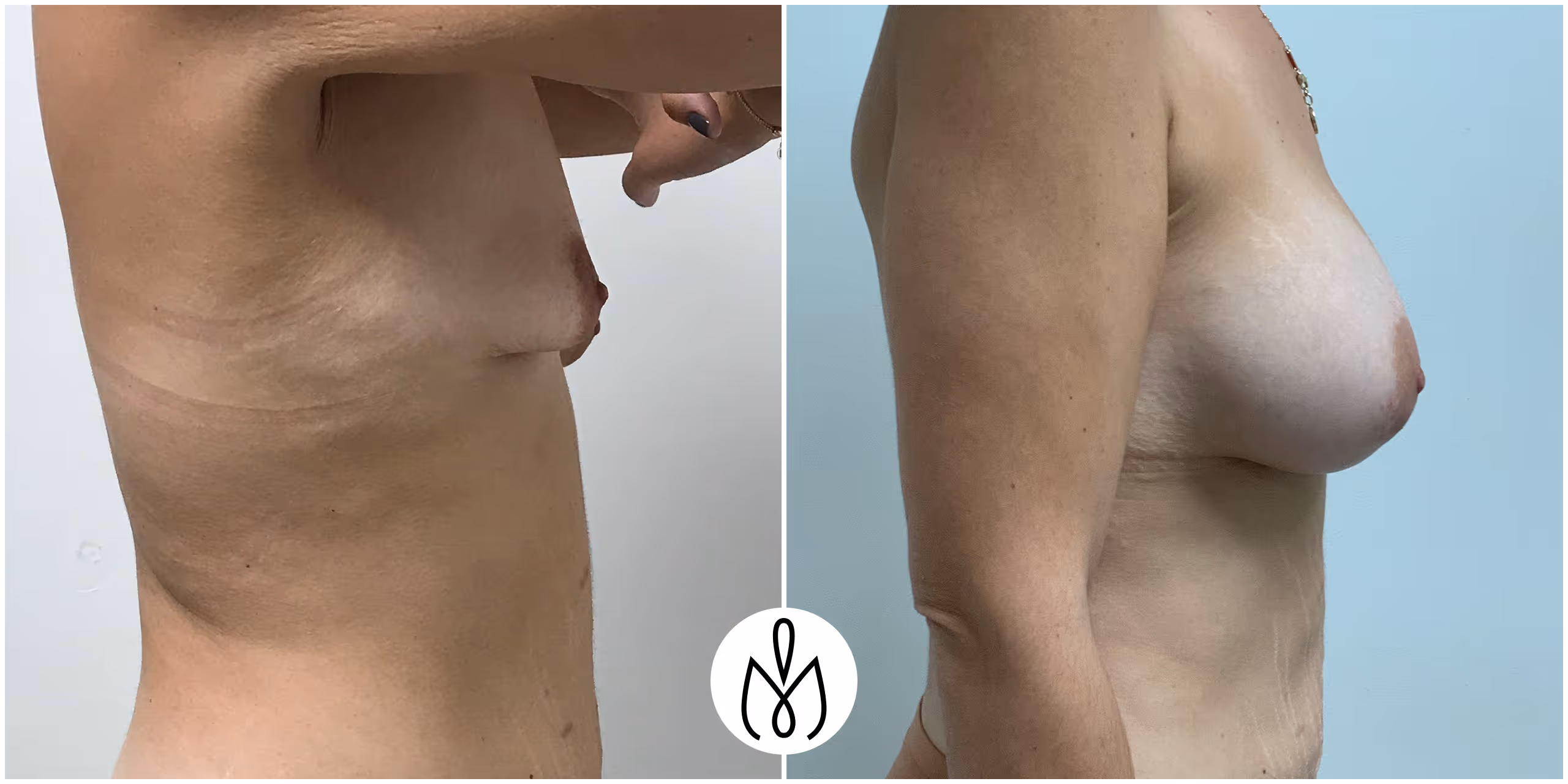 Before,After