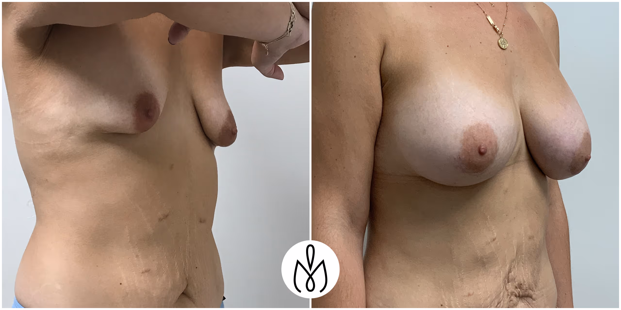 Before,After