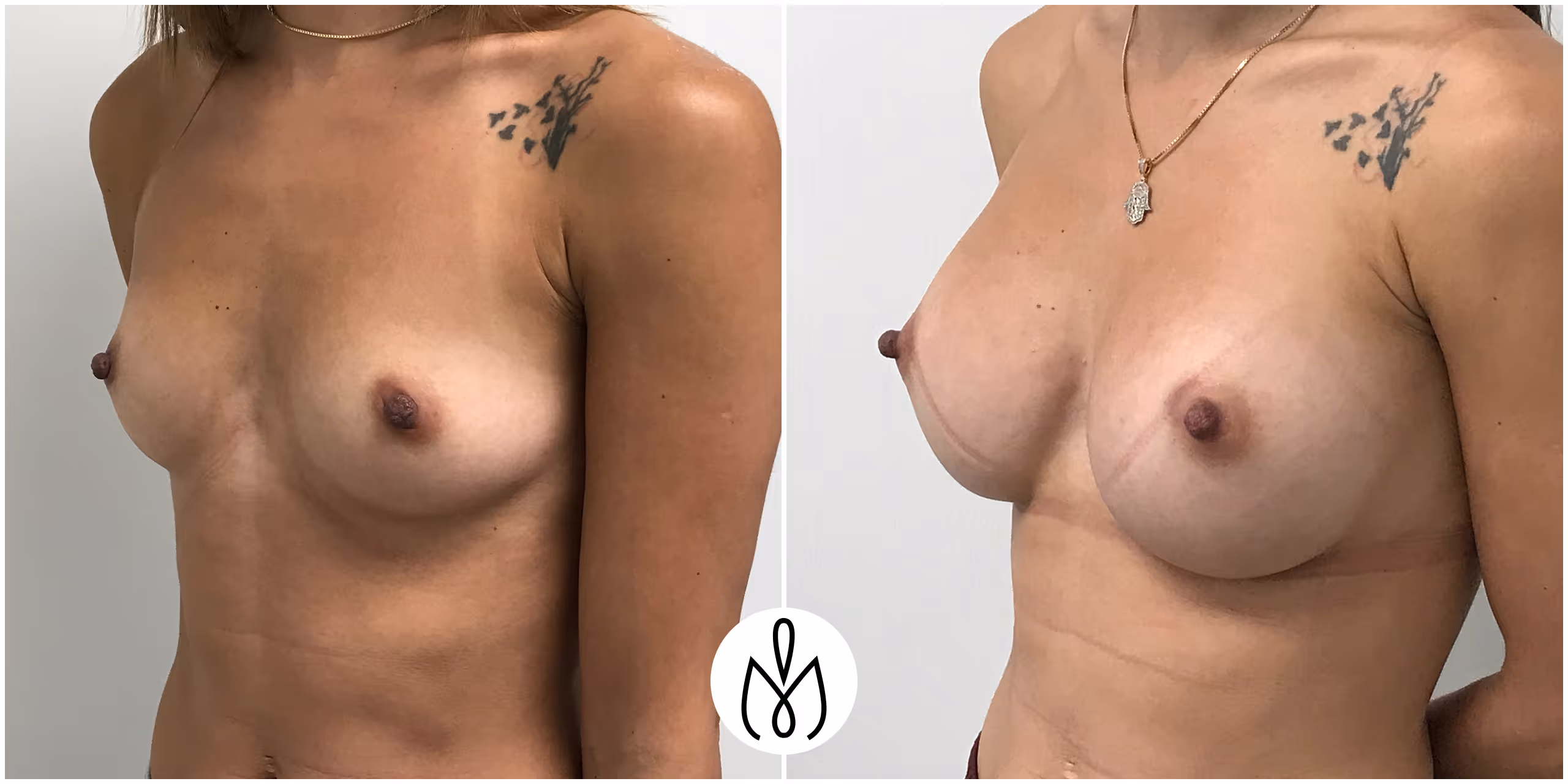 Before,After