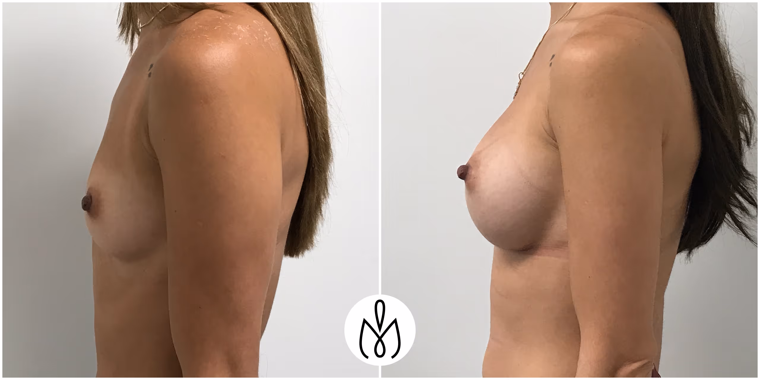 Before,After