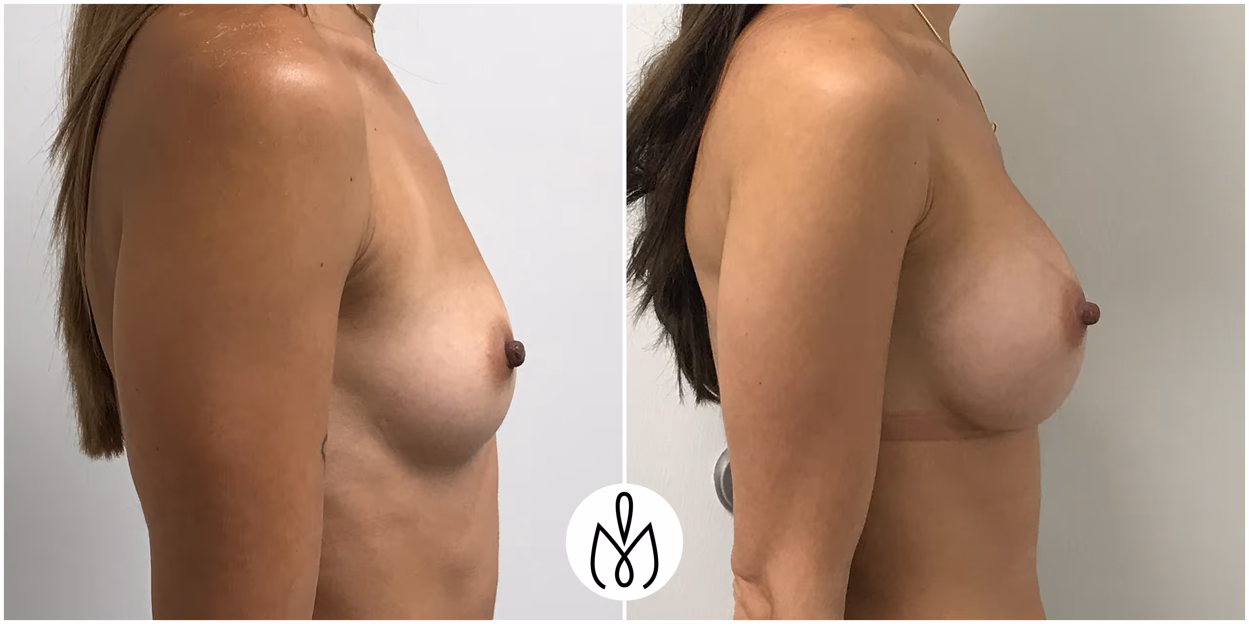 Before,After