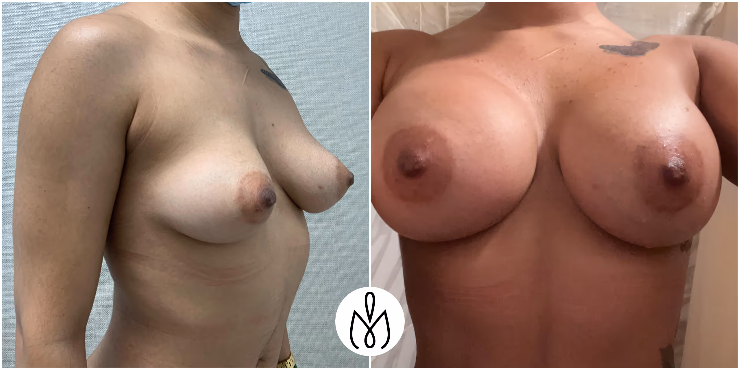 Before,After