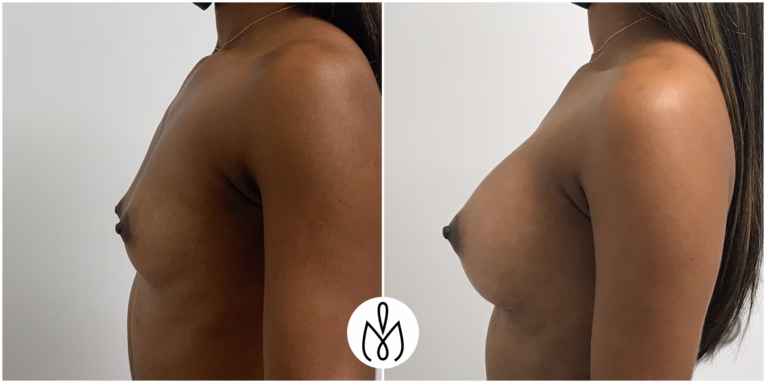 Before,After