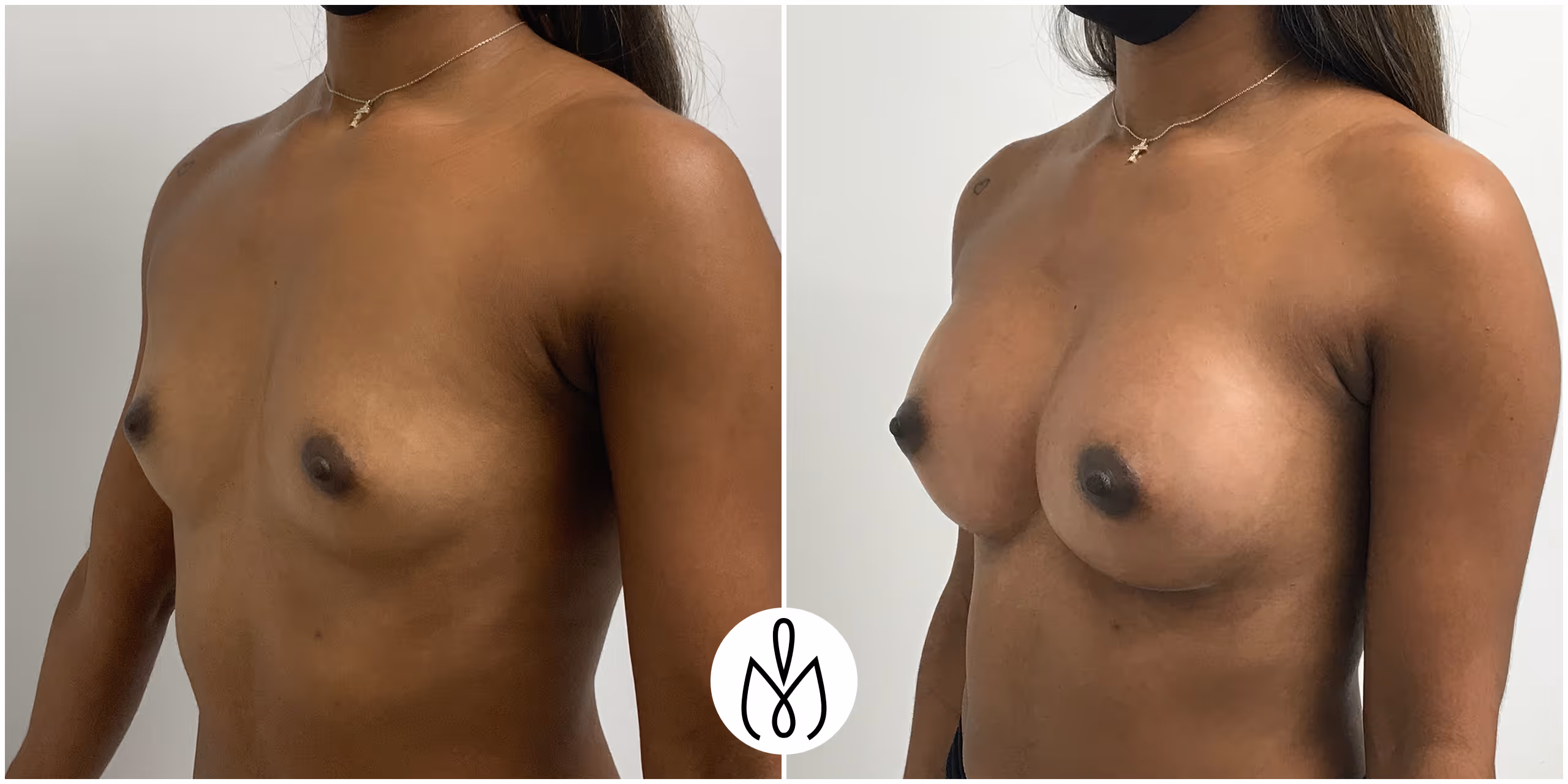 Before,After