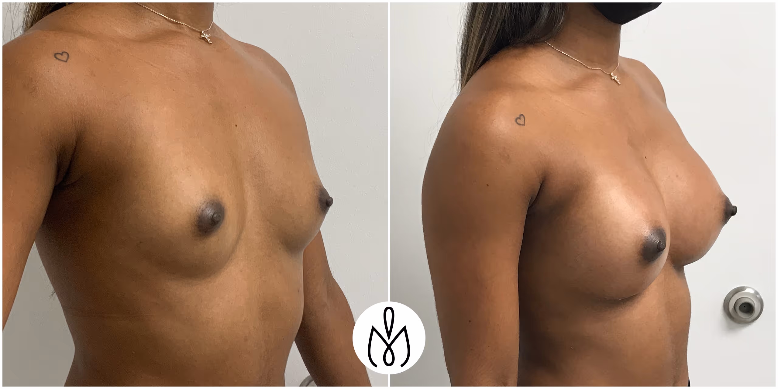 Before,After