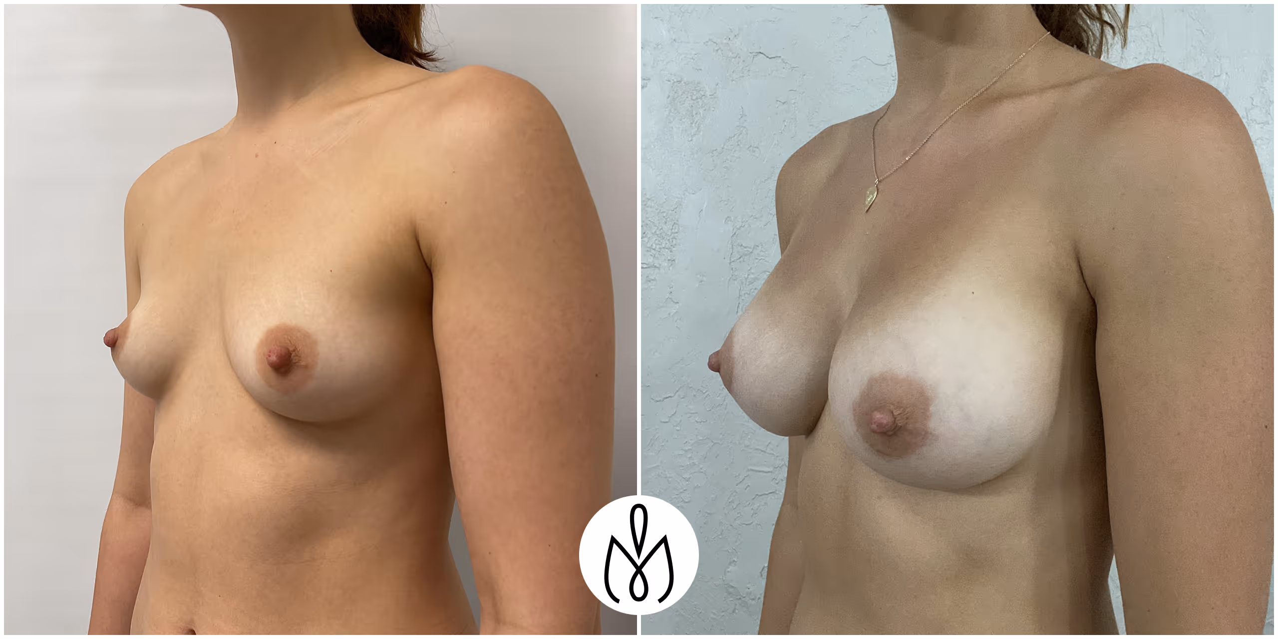 Before,After