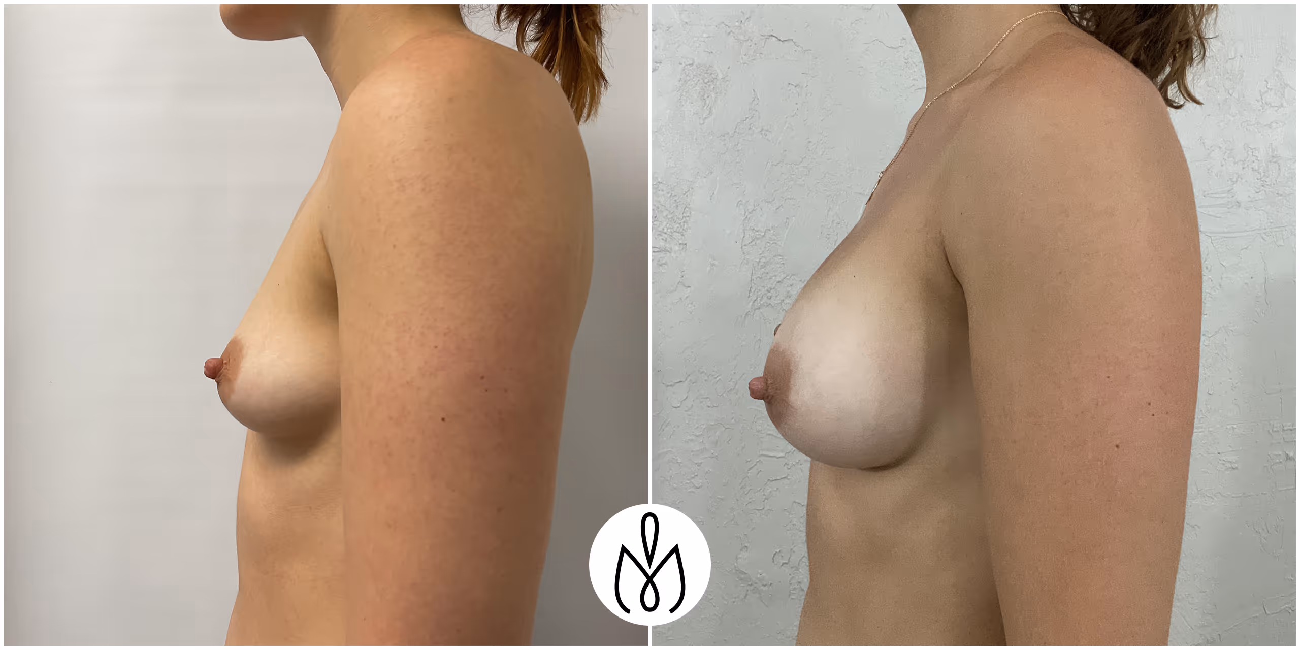 Before,After