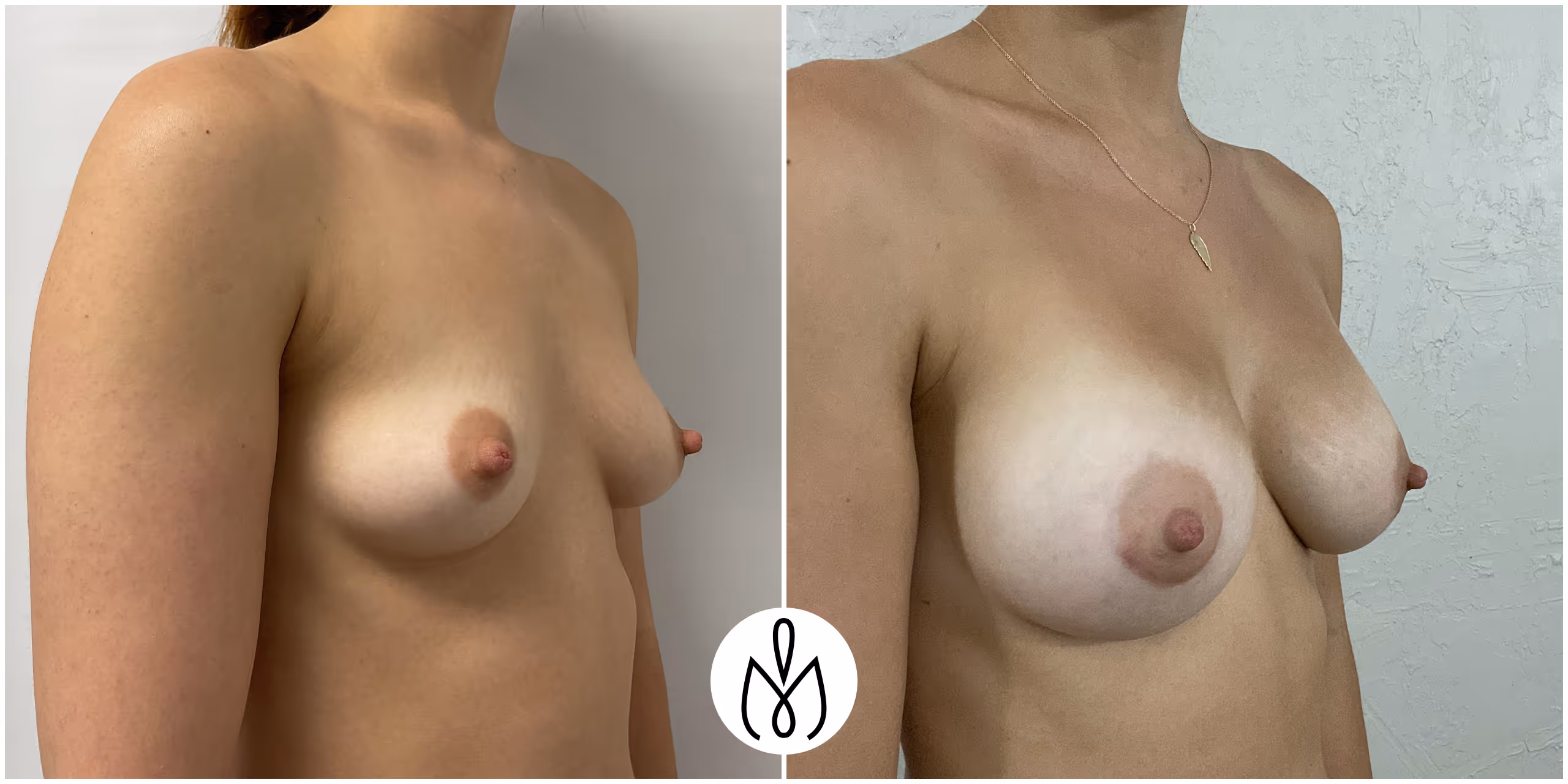 Before,After