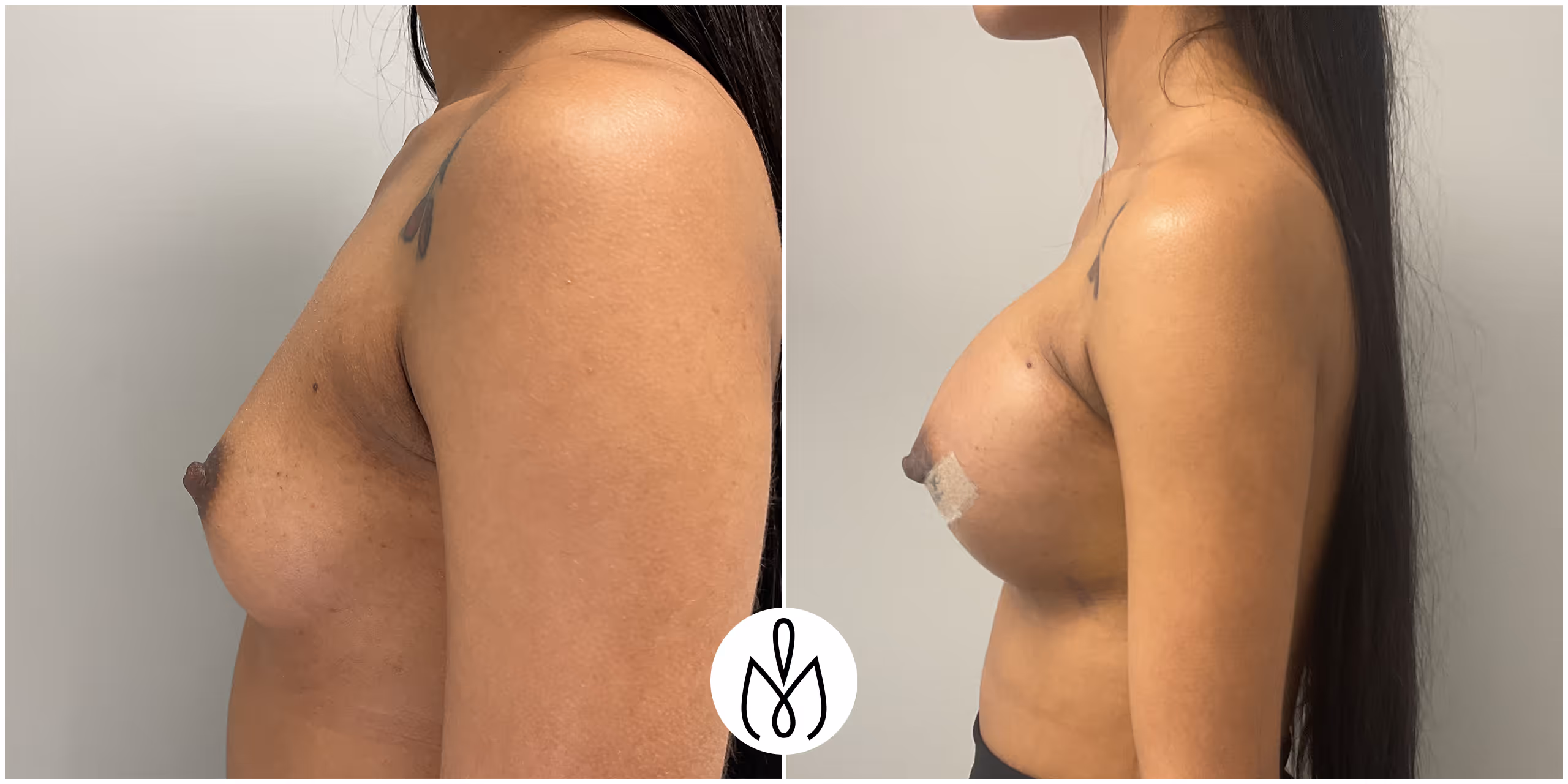 Before,After