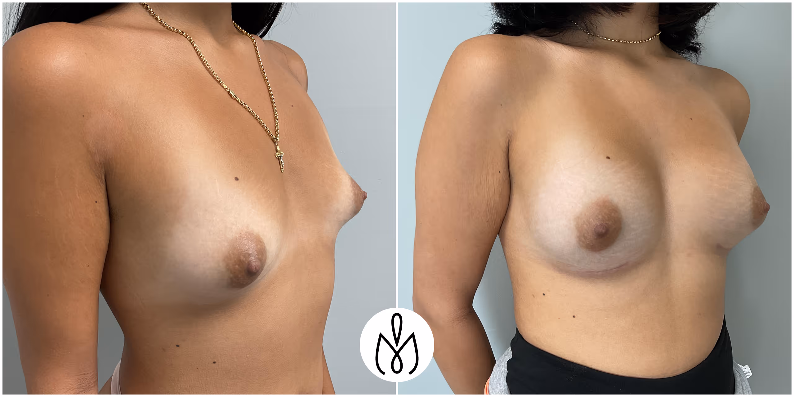 Before,After