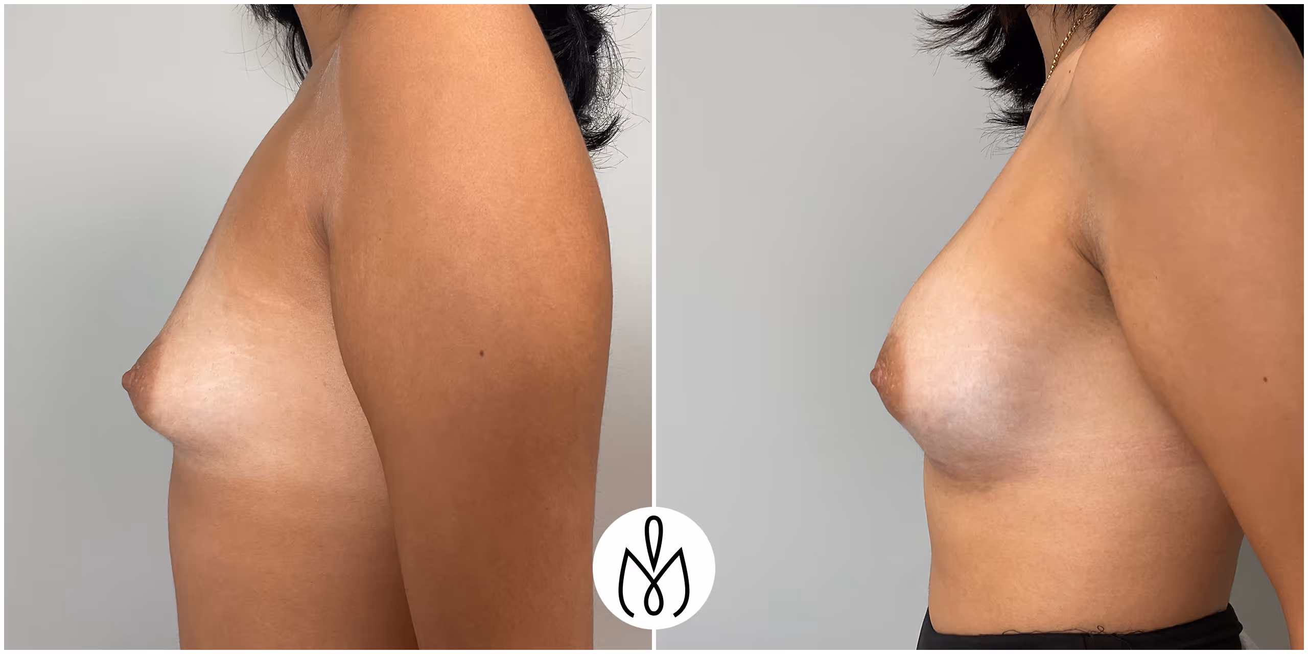Before,After