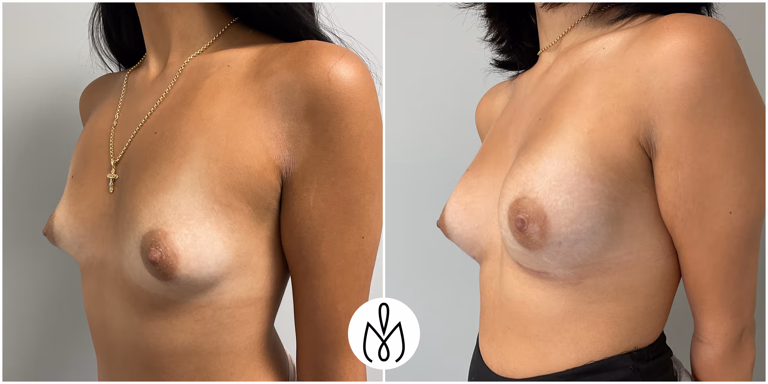 Before,After