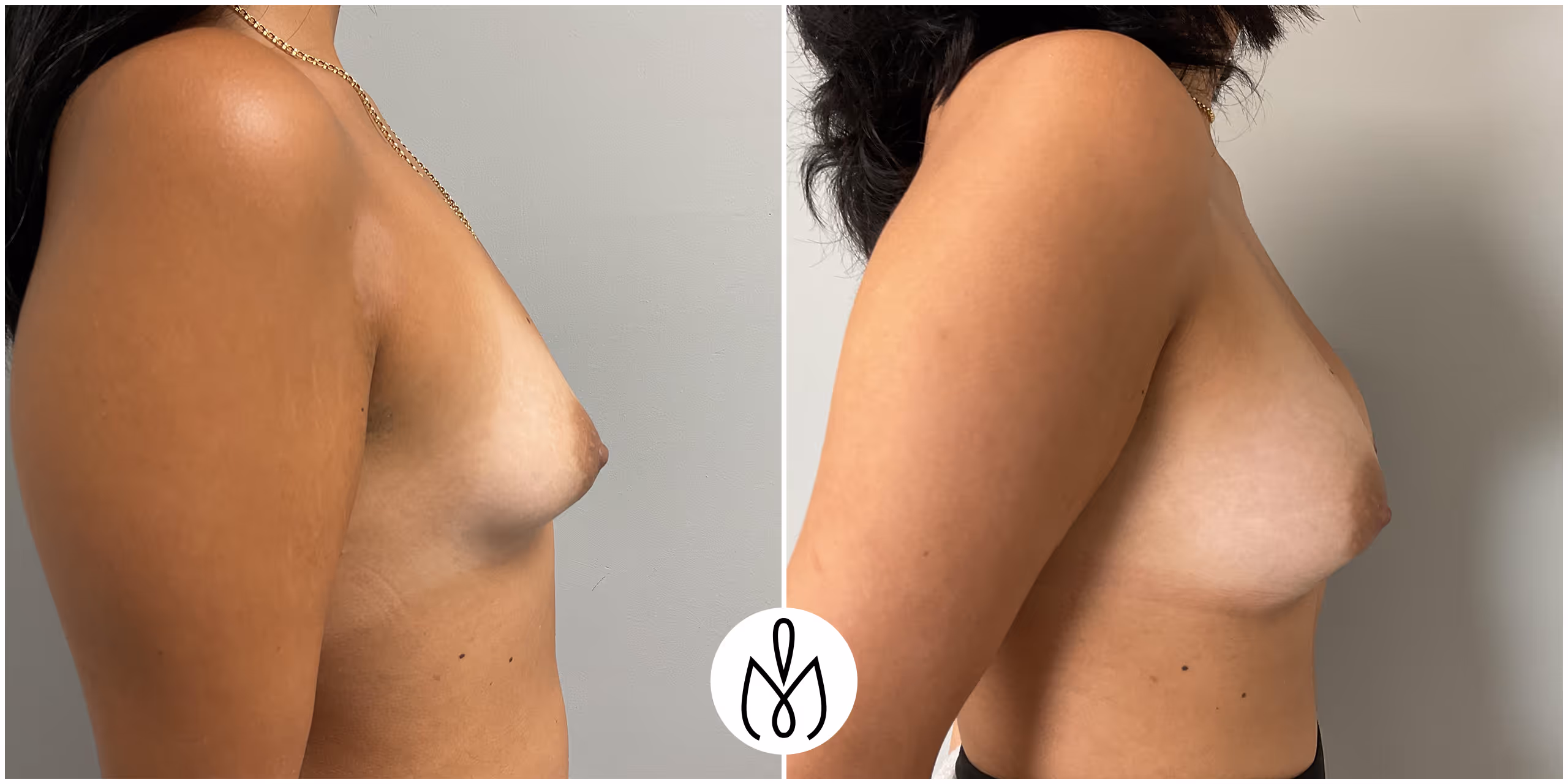 Before,After