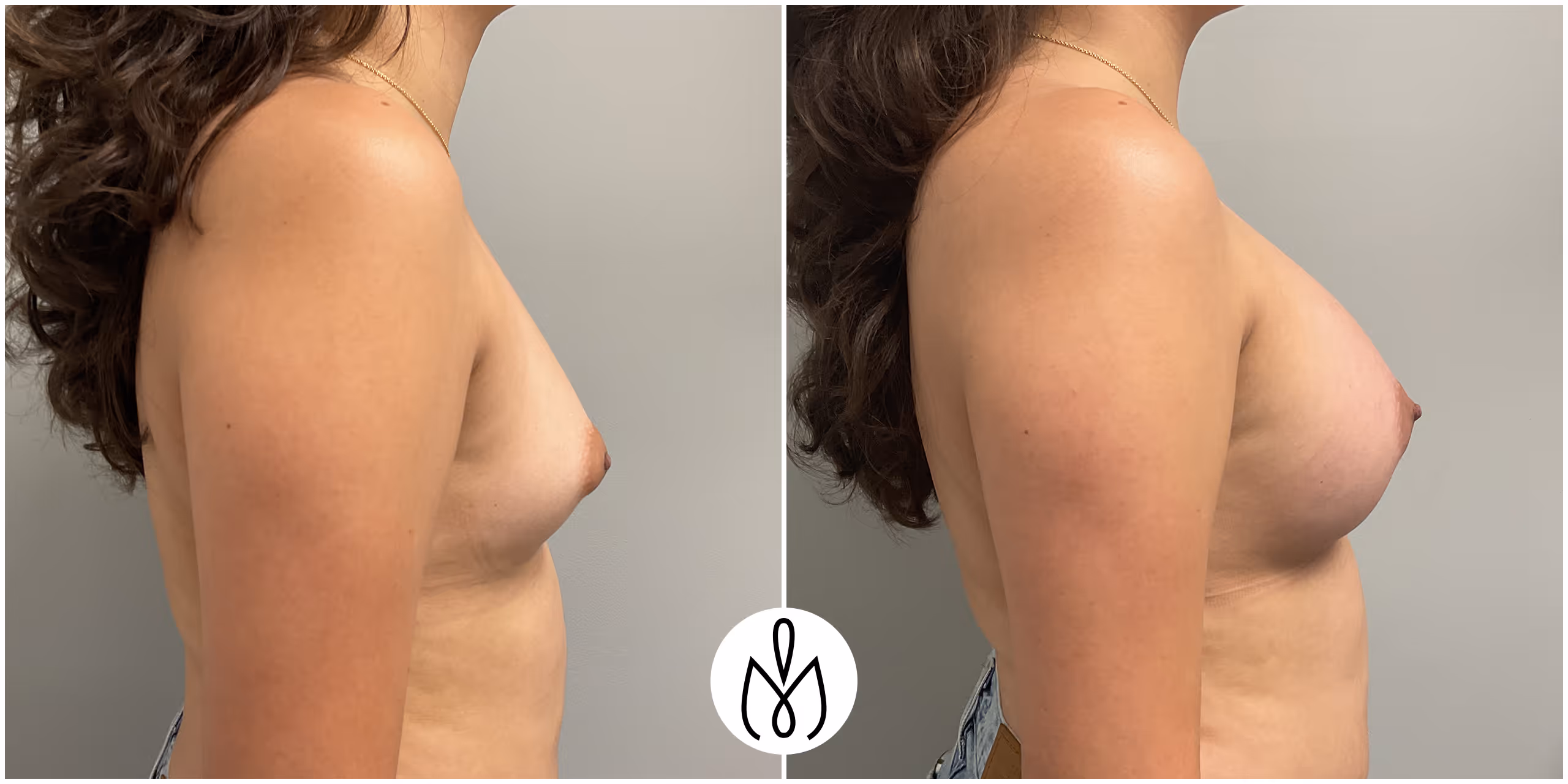 Before,After